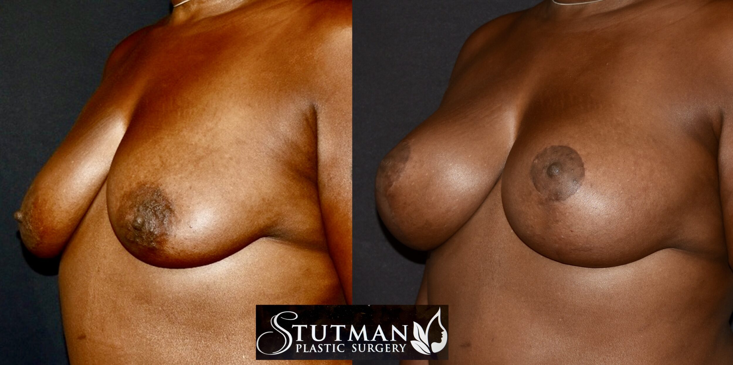 Before and After Image: Breast Lift - left-front-oblique