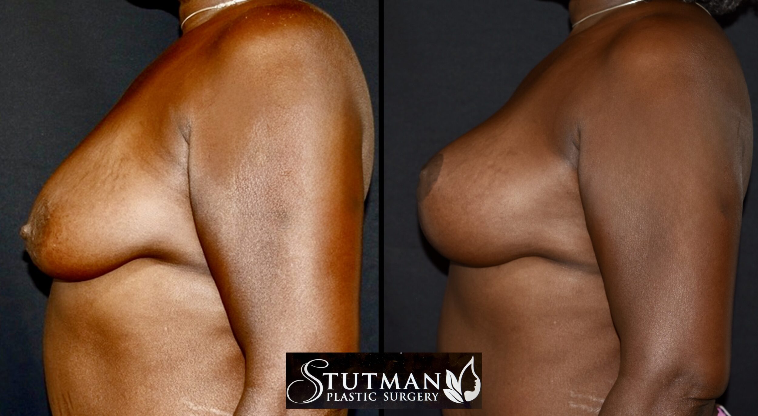 Before and After Image: Breast Lift - left-side