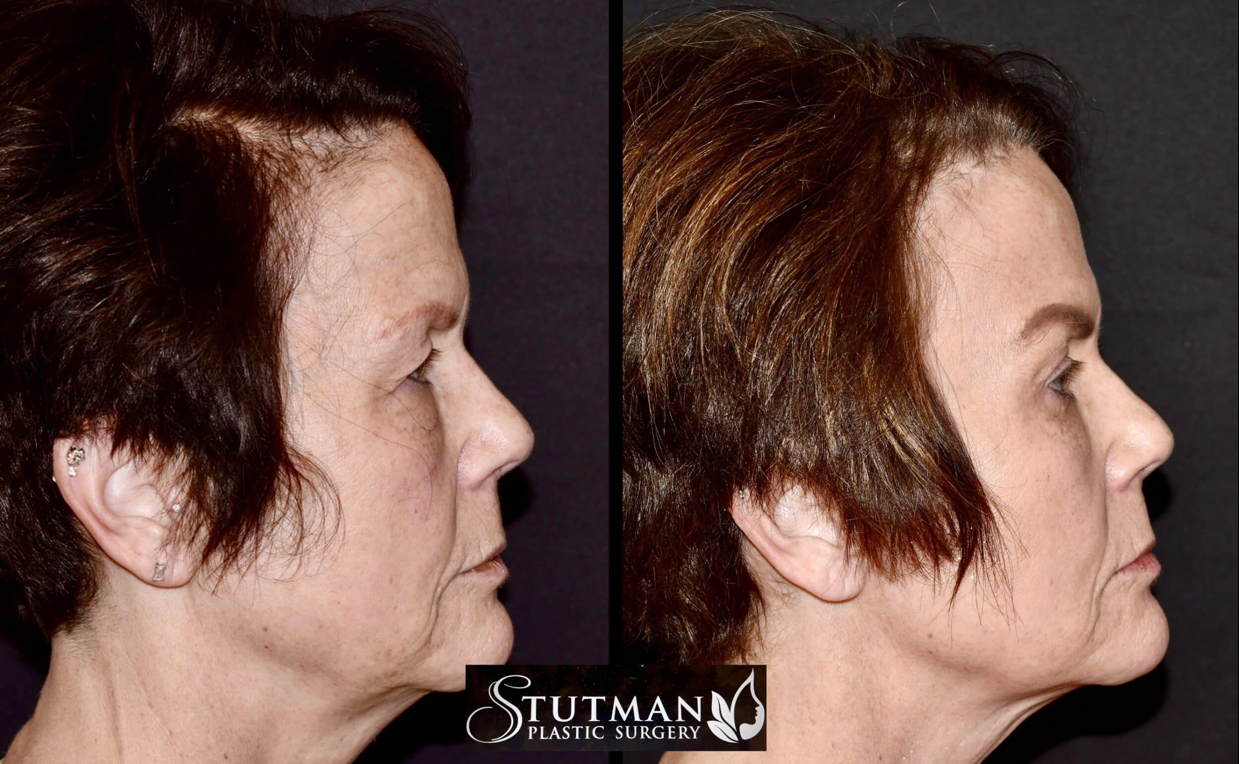 Before and After Image: Blepharoplasty and Browlift - right-side