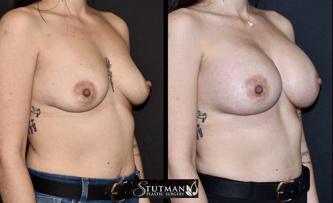 Before and After Image: Breast Augmentation - right-front-oblique