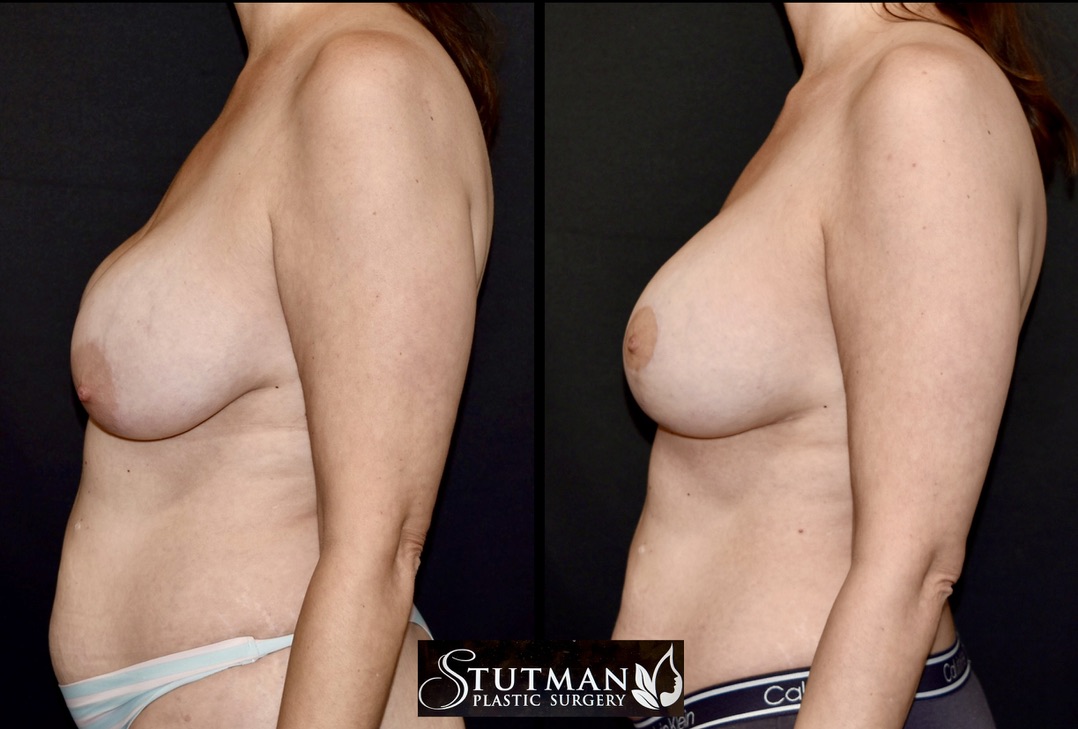 Before and After Image: Mastopexy (Breast Lift) - left-side