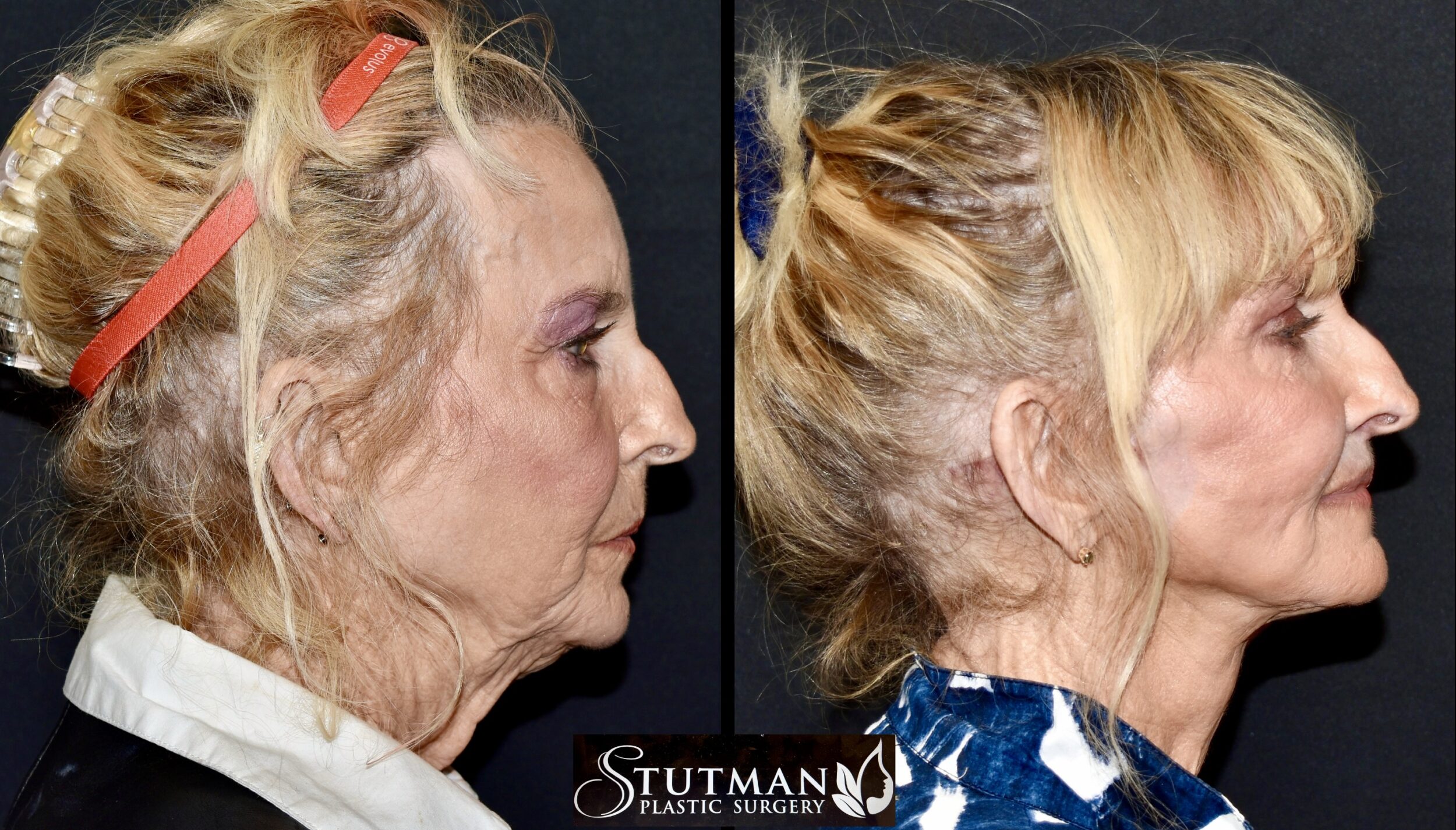 Before and After Image: Facelift/Necklift - right-side