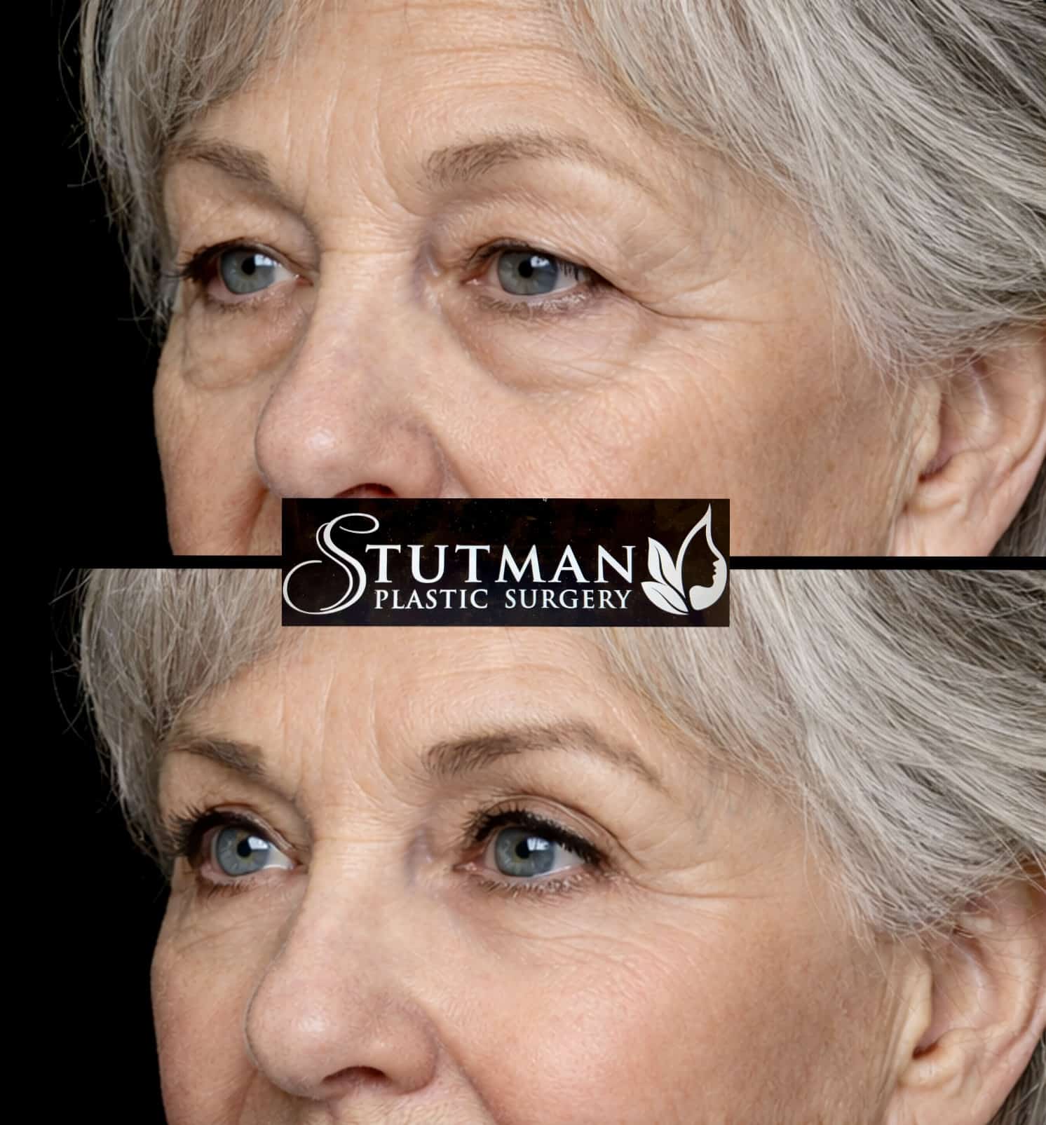 Before and After Image: Blepharoplasty - left-front-oblique
