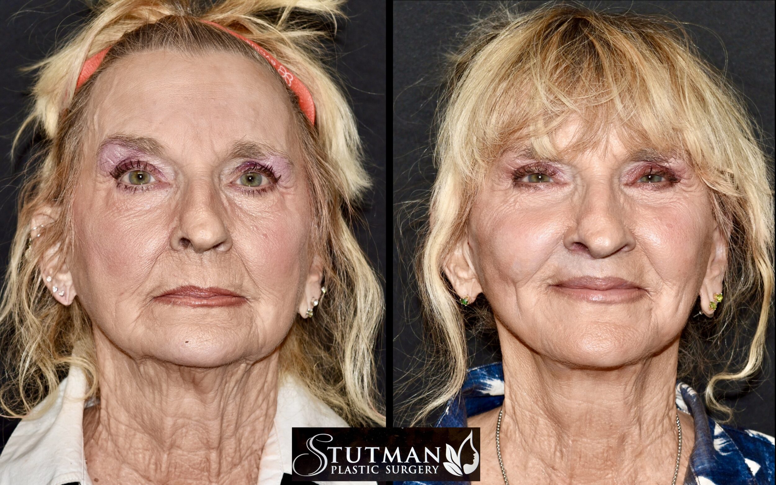 Before and After Image: Facelift/Necklift - front