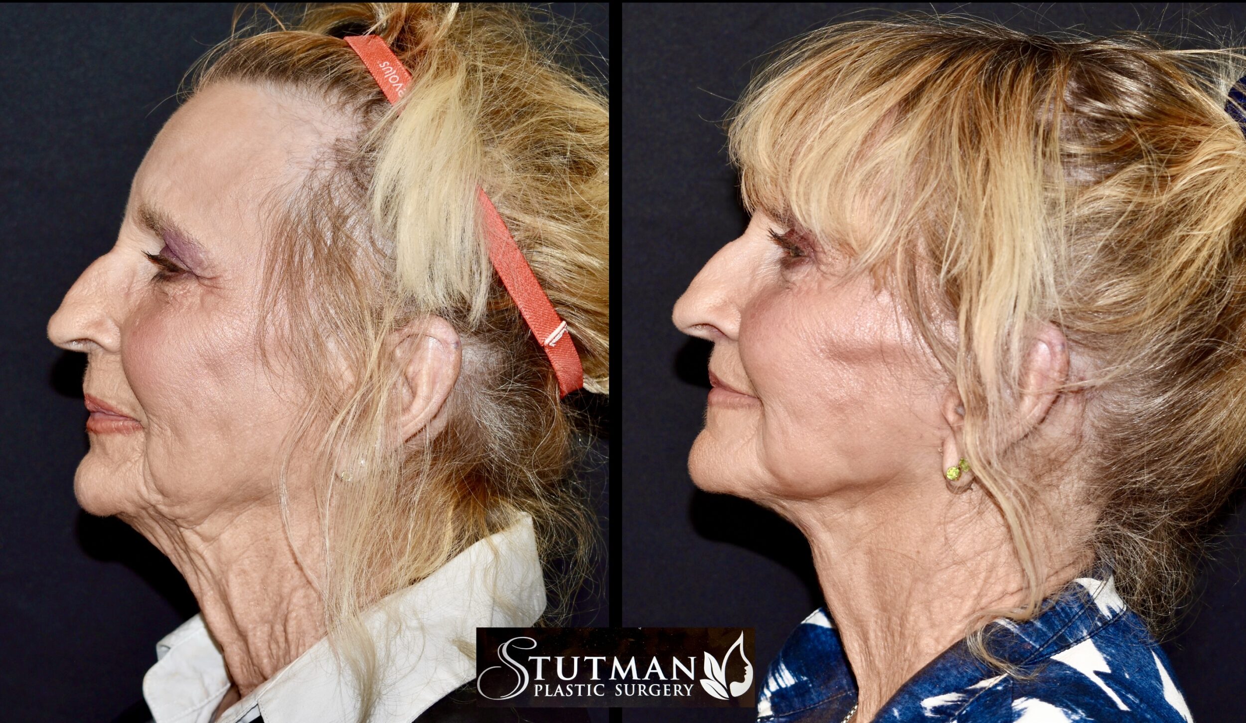 Before and After Image: Facelift/Necklift - left-side