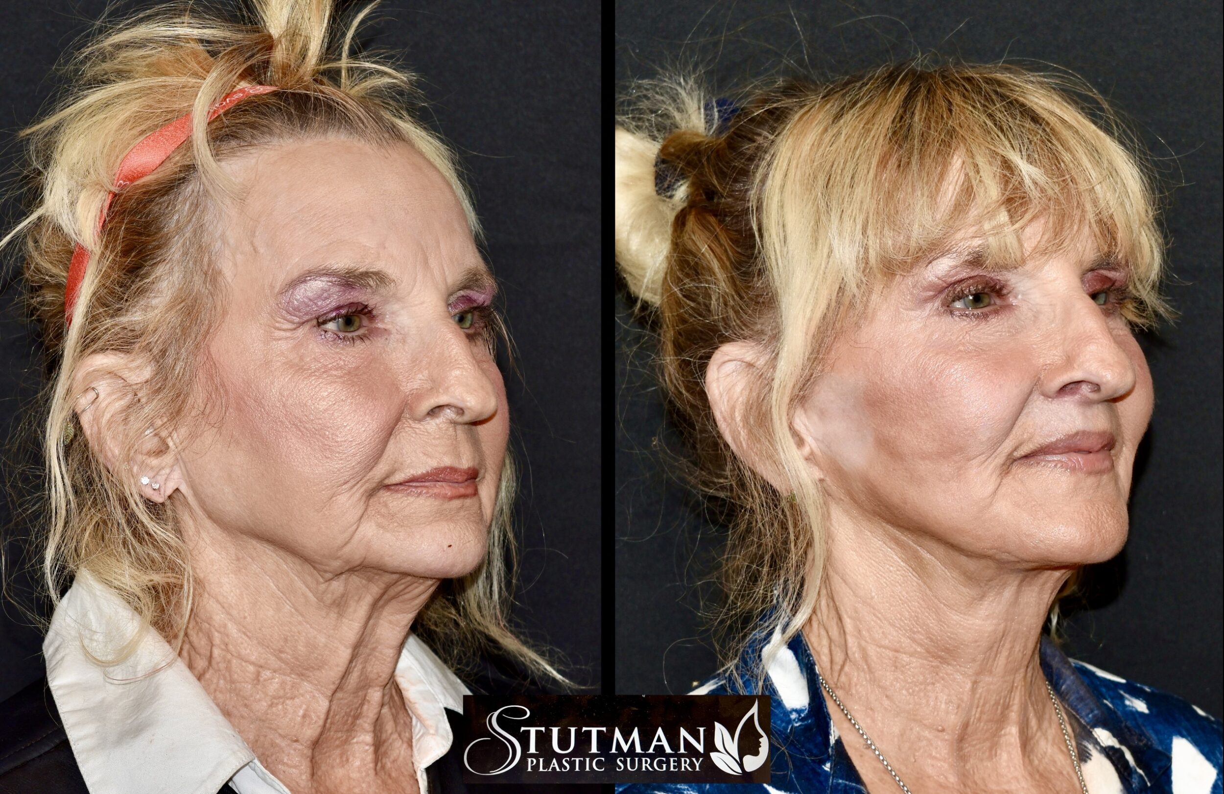 Before and After Image: Facelift/Necklift - right-front-oblique