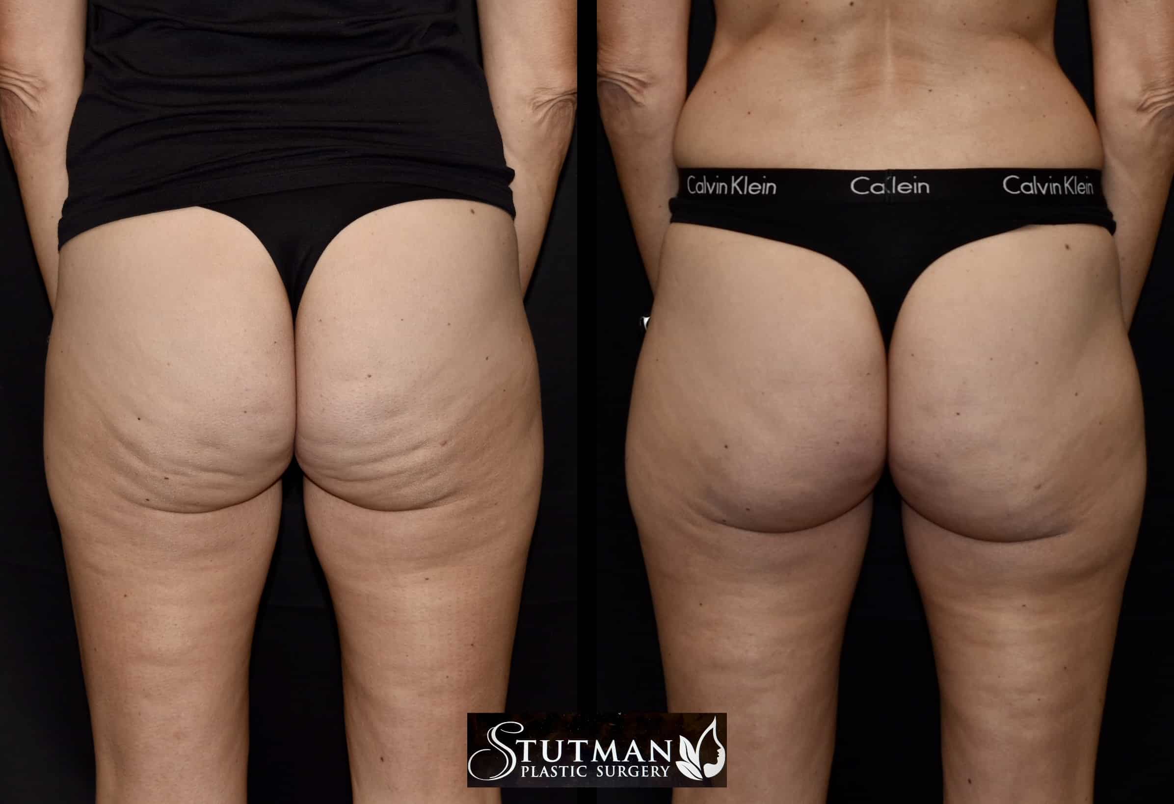 Before and After Image: Cellulite - back