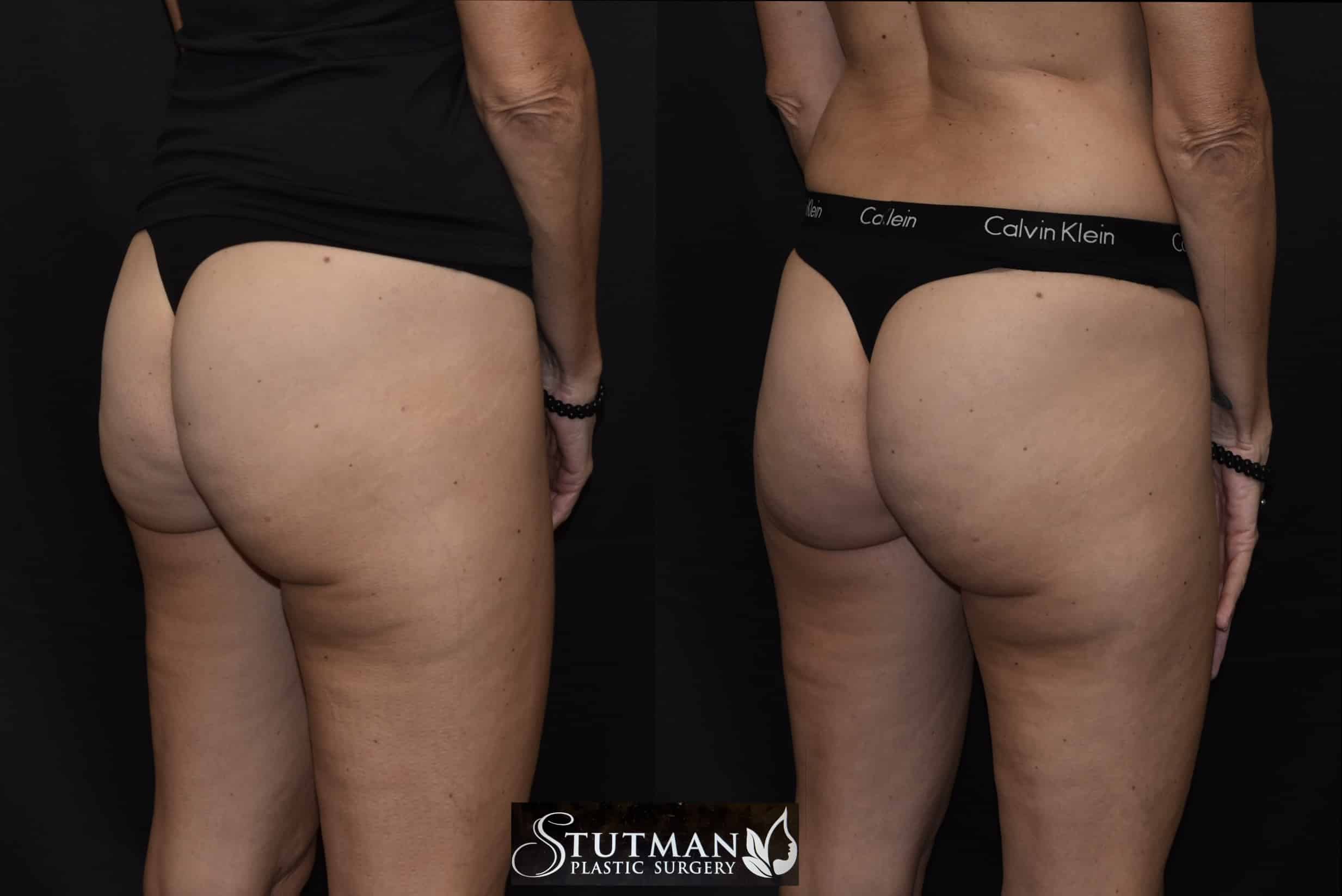Before and After Image: Cellulite - right-back-oblique