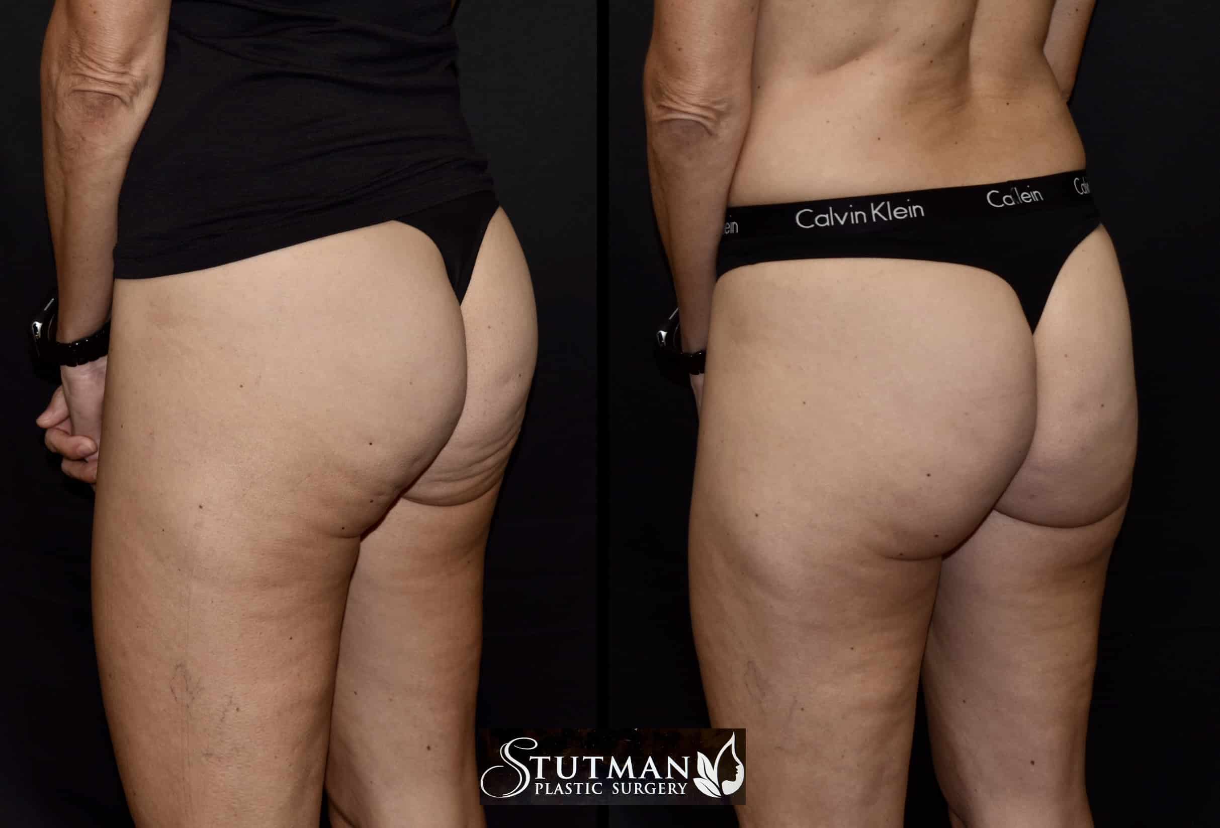 Before and After Image: Cellulite - left-back-oblique