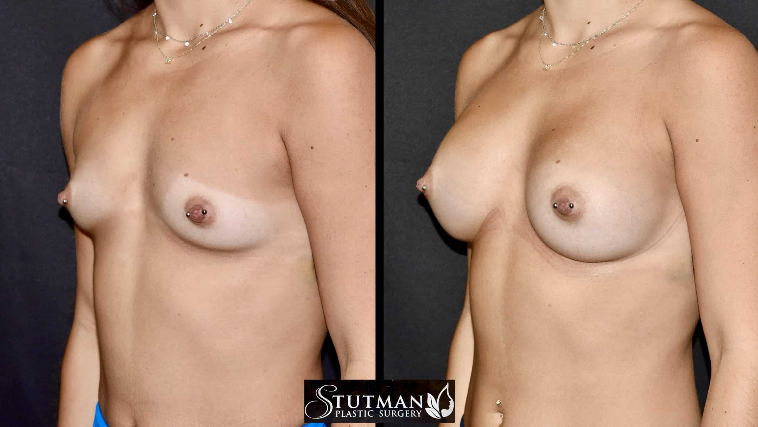 Before and After Image: Breast Augmentation - left-front-oblique
