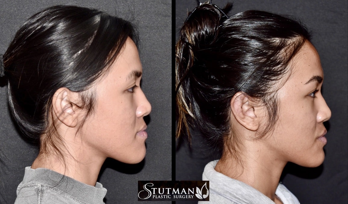Before and After Image: Otoplasty(Ear Pinning) - right-side
