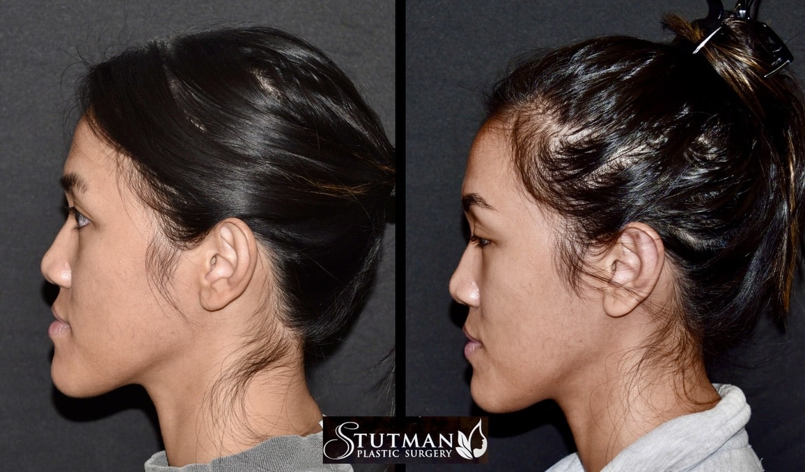 Before and After Image: Otoplasty(Ear Pinning) - left-side
