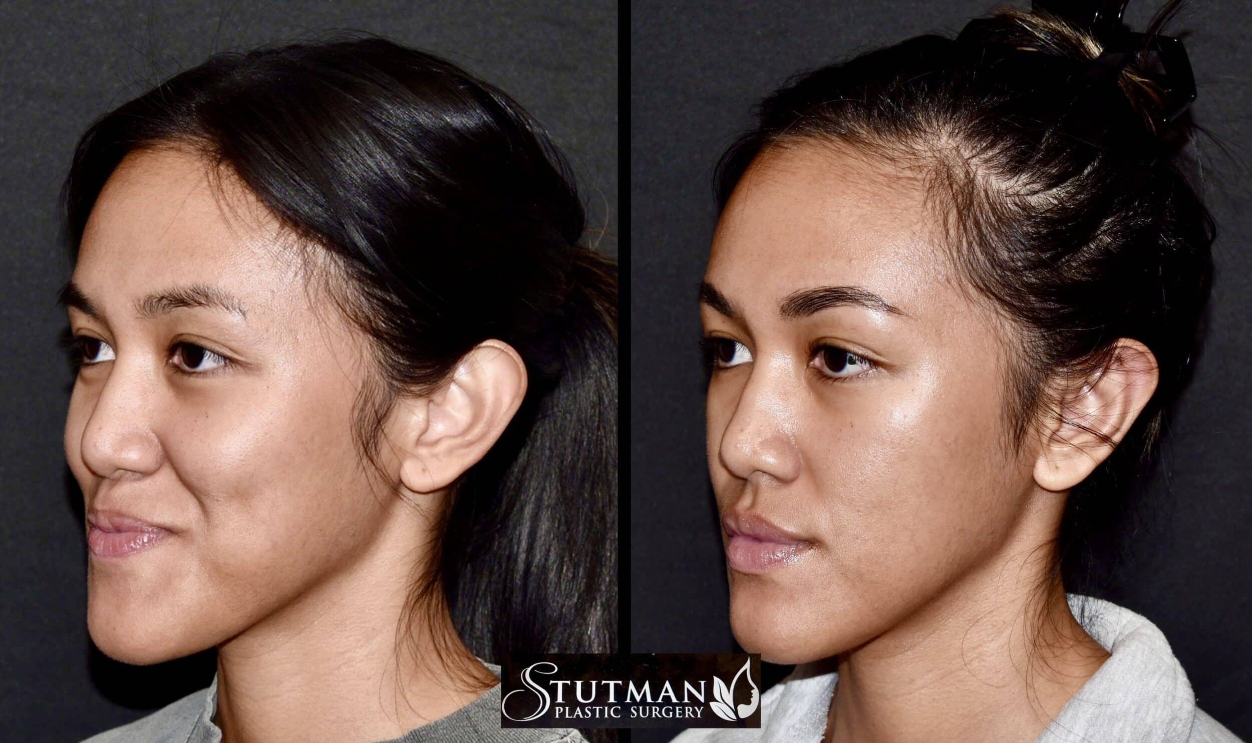 Before and After Image: Otoplasty(Ear Pinning) - left-front-oblique