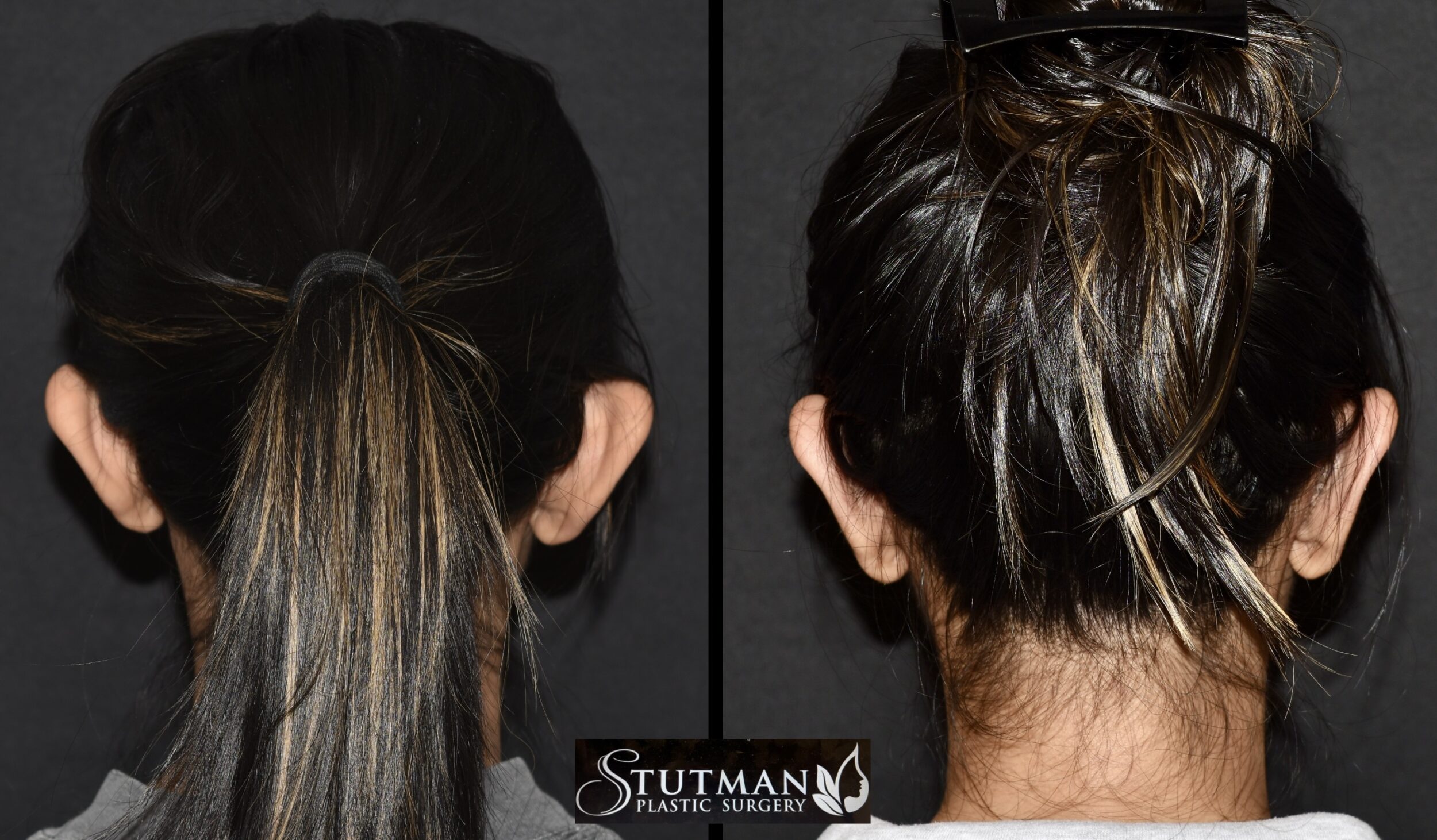 Before and After Image: Otoplasty(Ear Pinning) - back
