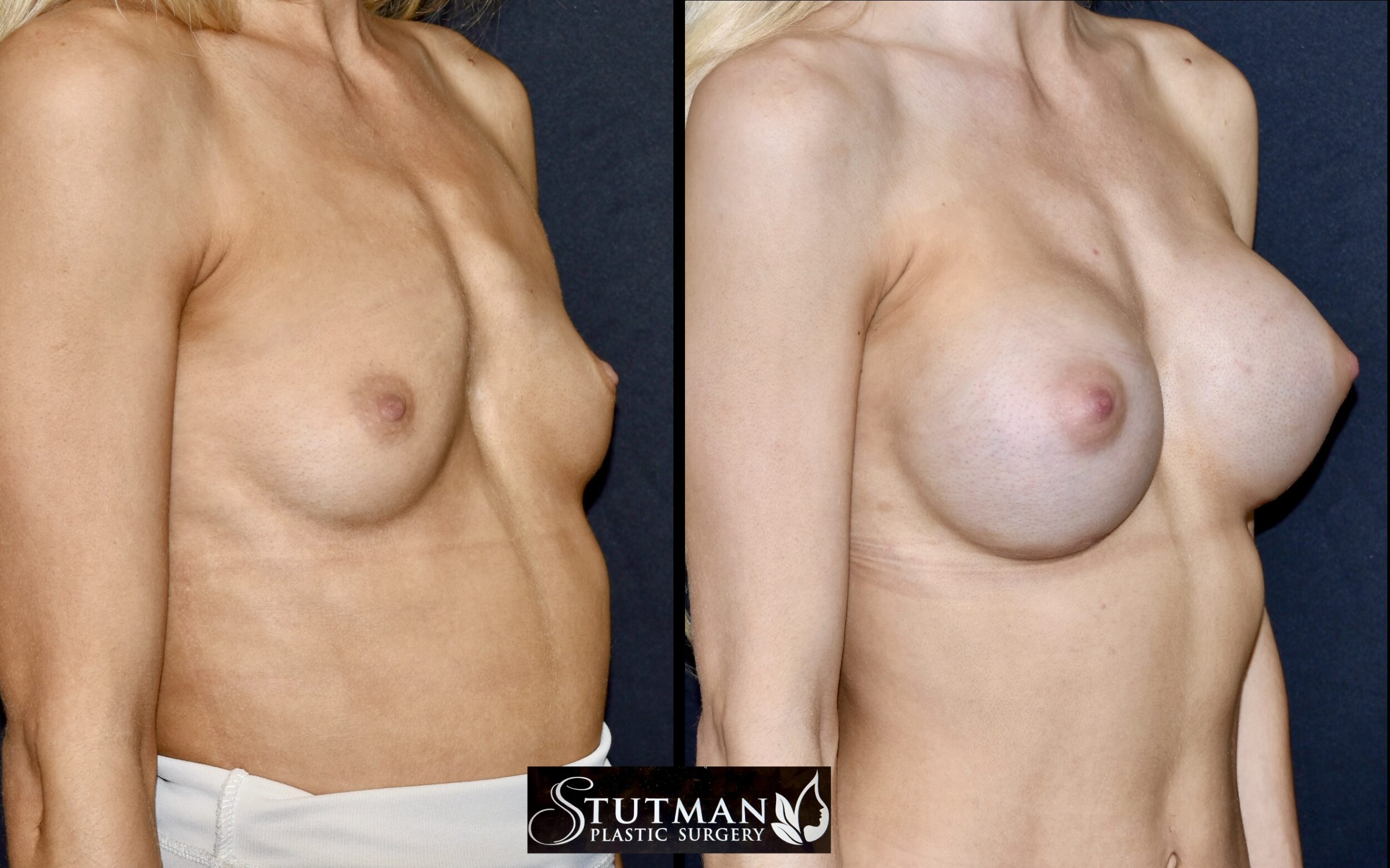Before and After Image: Breast Augmentation - right-front-oblique