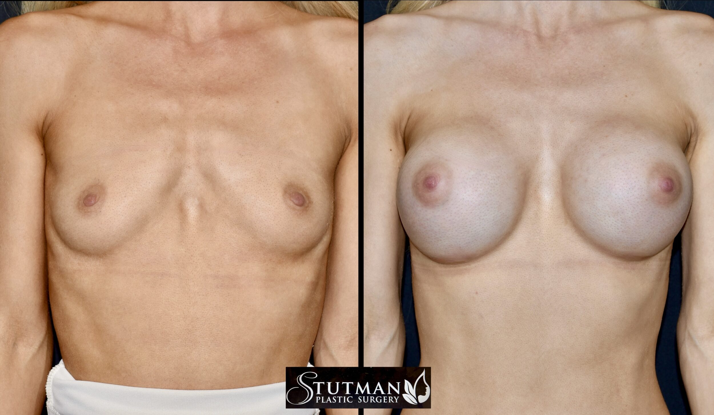 Before and After Image: Breast Augmentation - front