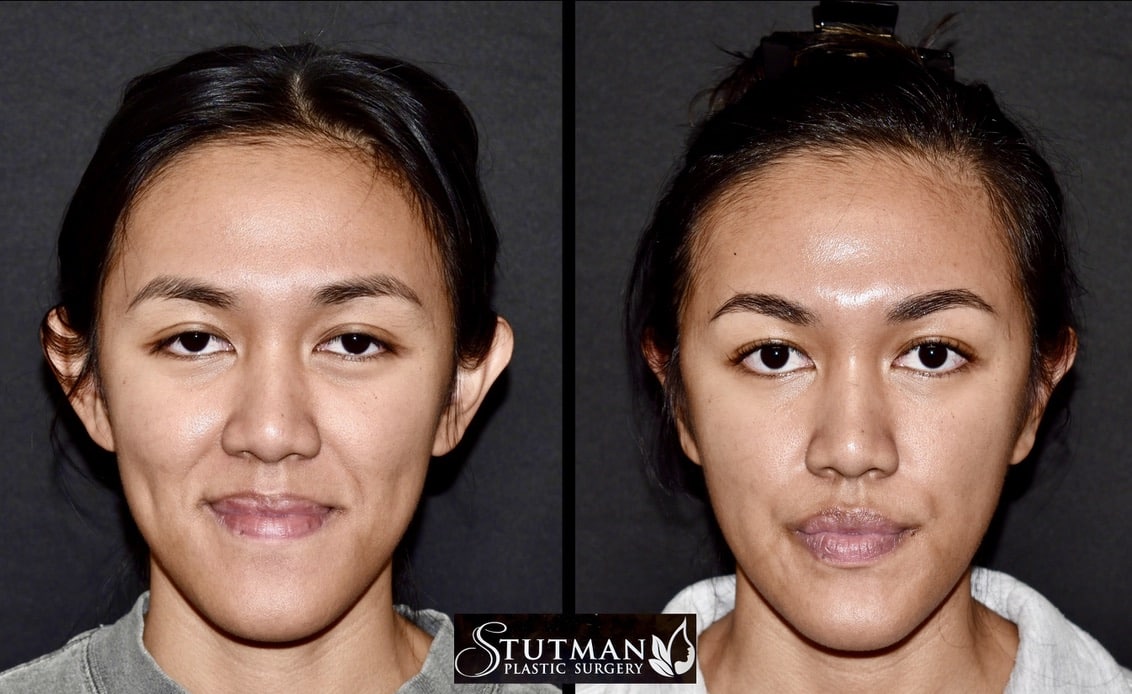 Before and After Image: Otoplasty(Ear Pinning) - front