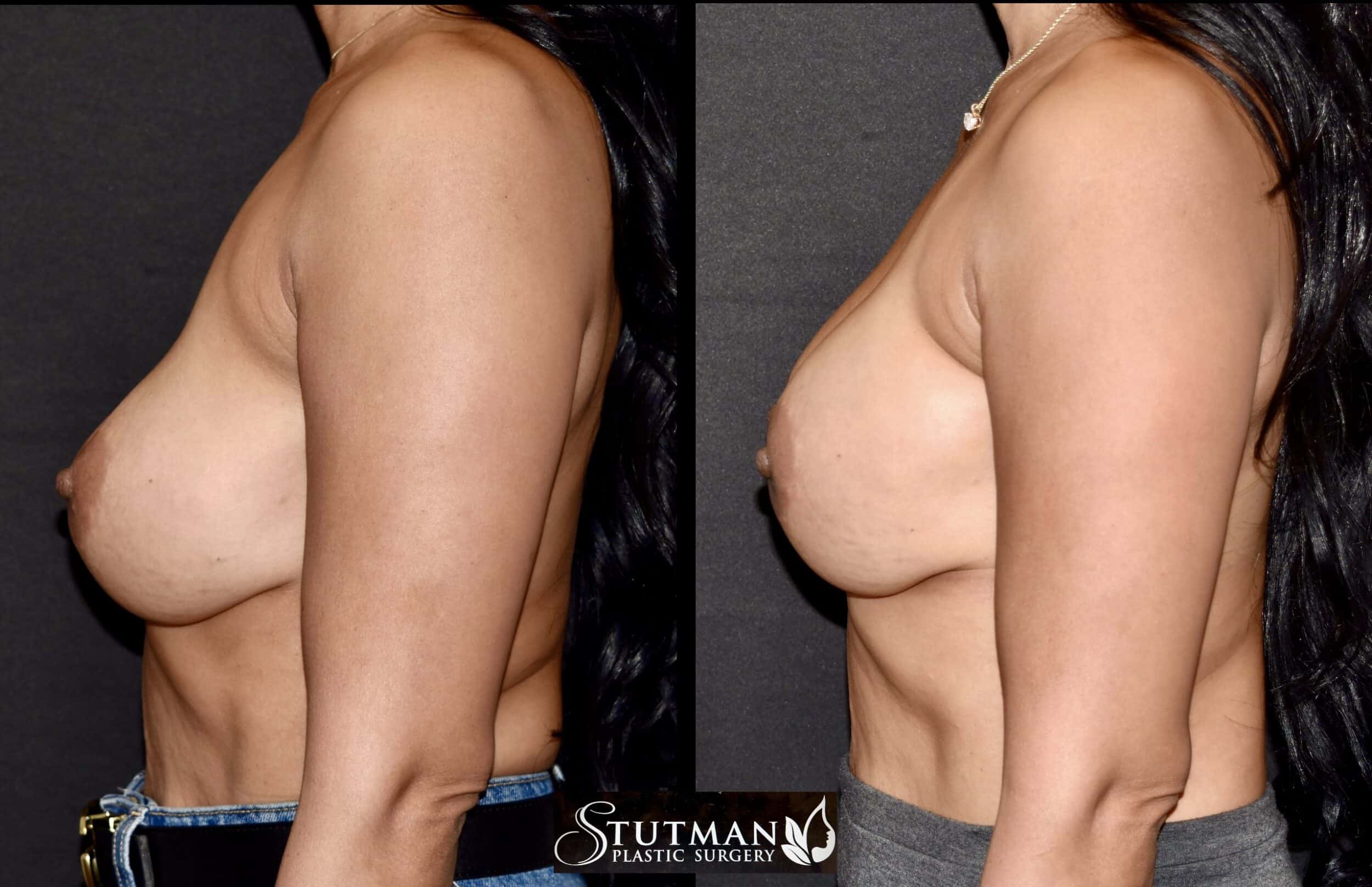 Before and After Image: Revision Breast Surgery - left-side