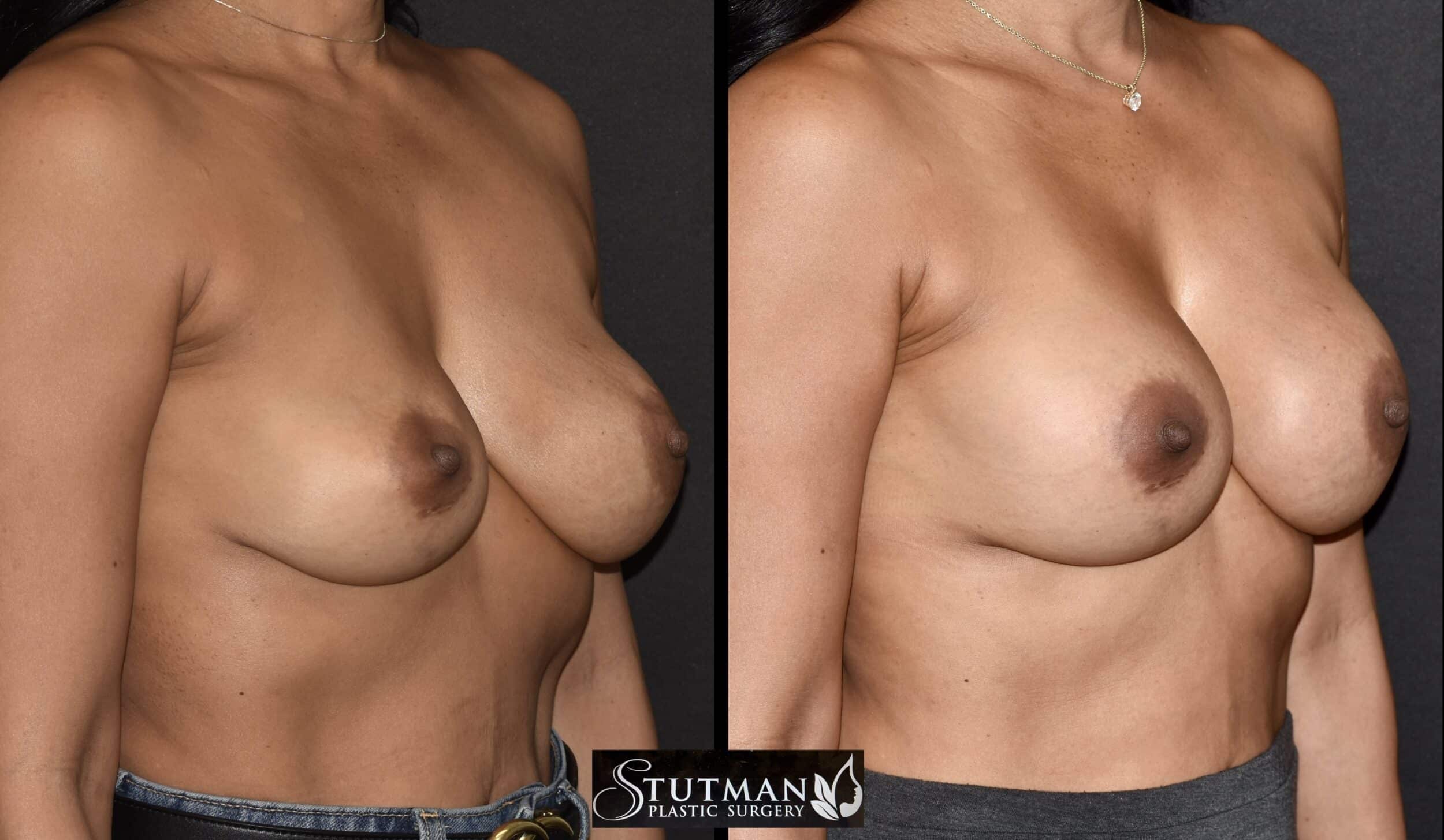 Before and After Image: Revision Breast Surgery - right-front-oblique