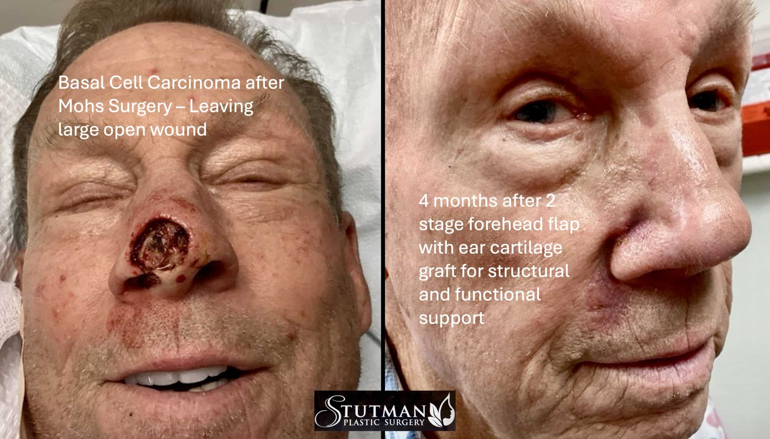 Before and After Image: Nose skin cancer - right-front-oblique