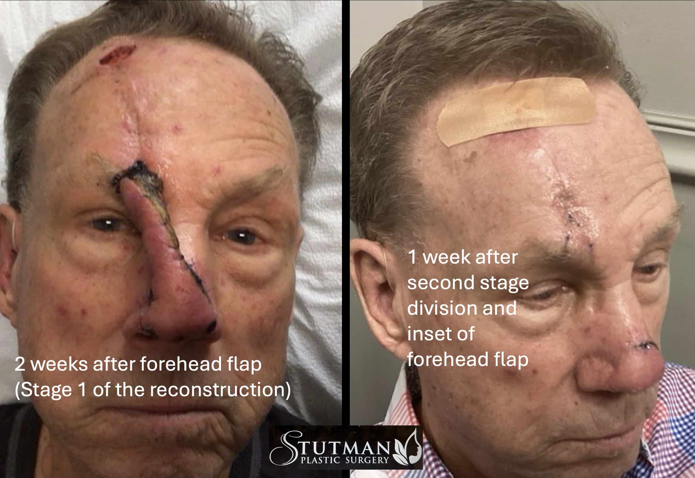 Before and After Image: Nose skin cancer - right-side