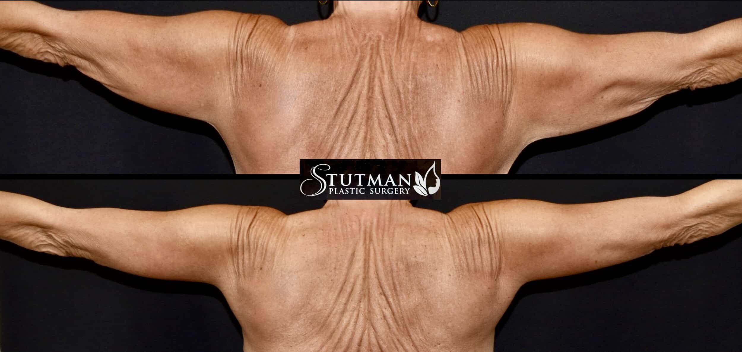 Before and After Image: Brachioplasty (arm lift) -
