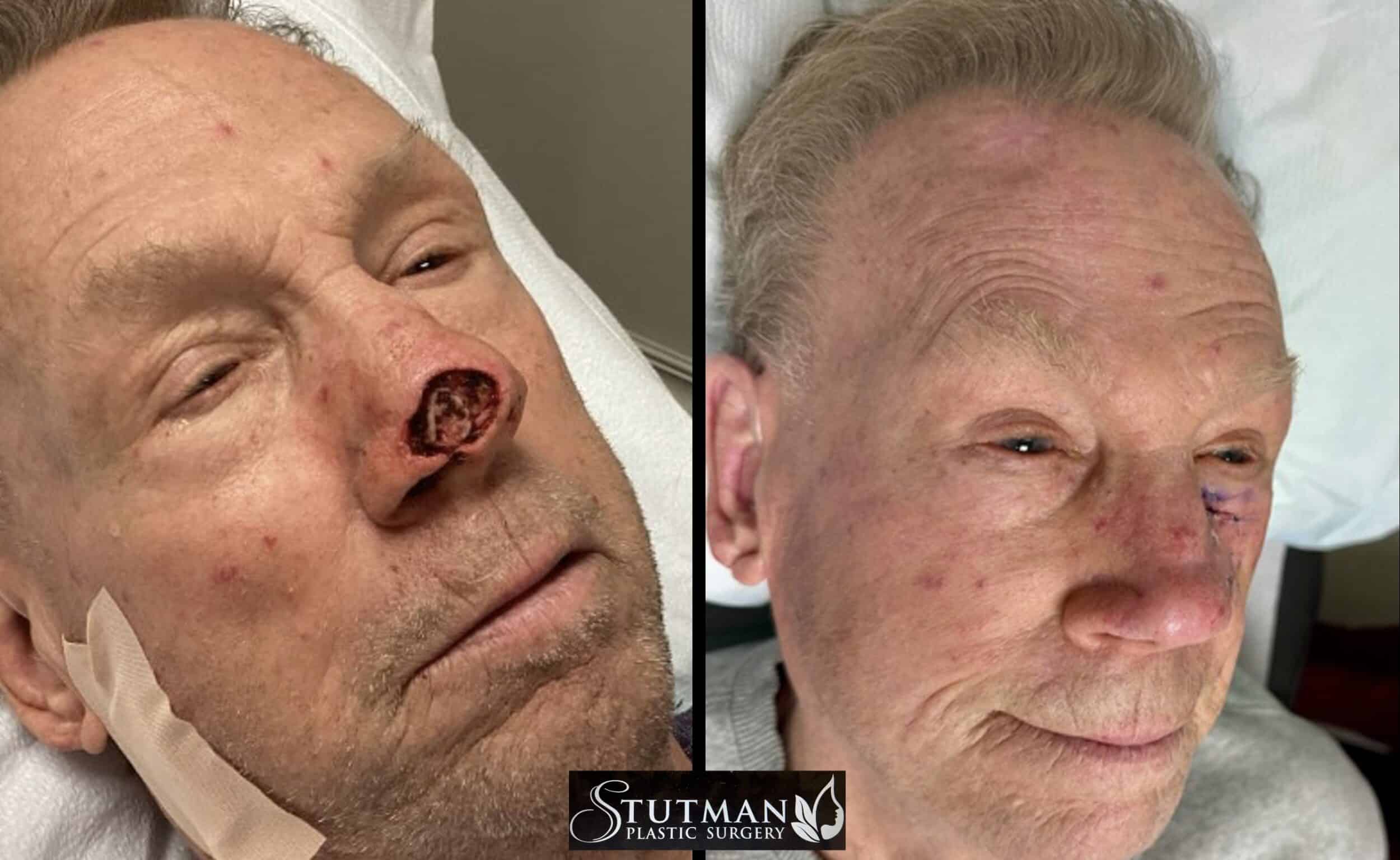 Before and After Image: Nose skin cancer - front