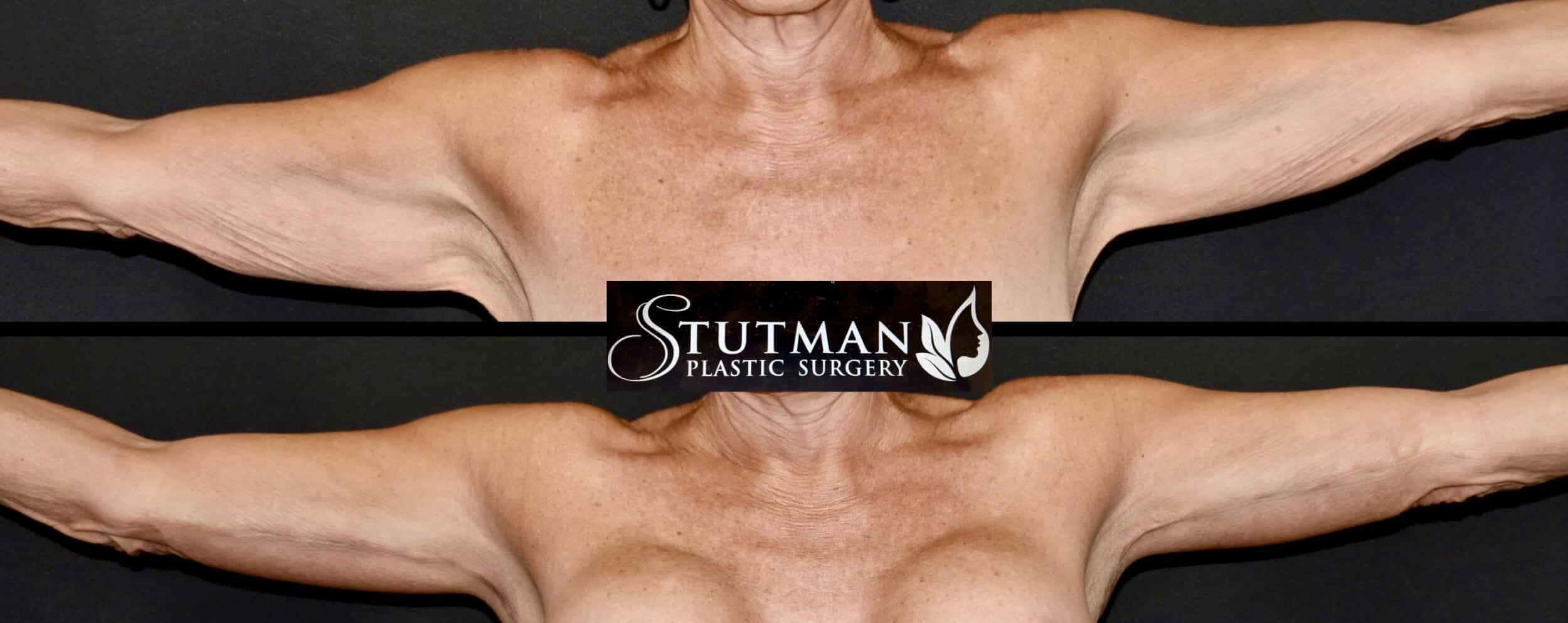 Before and After Image: Brachioplasty (arm lift) - front