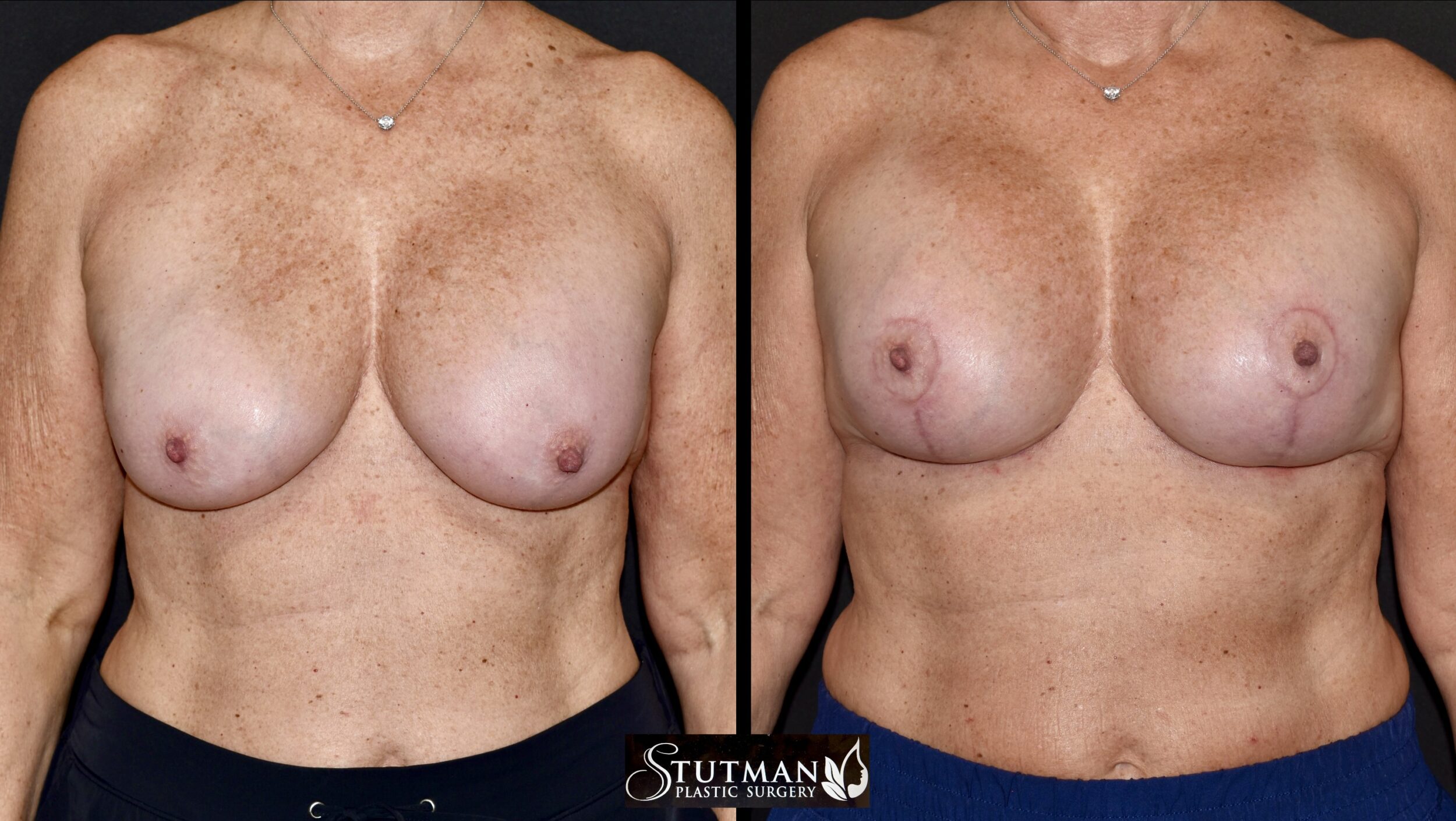 Before and After Image: Mastopexy (Breast Lift) - front