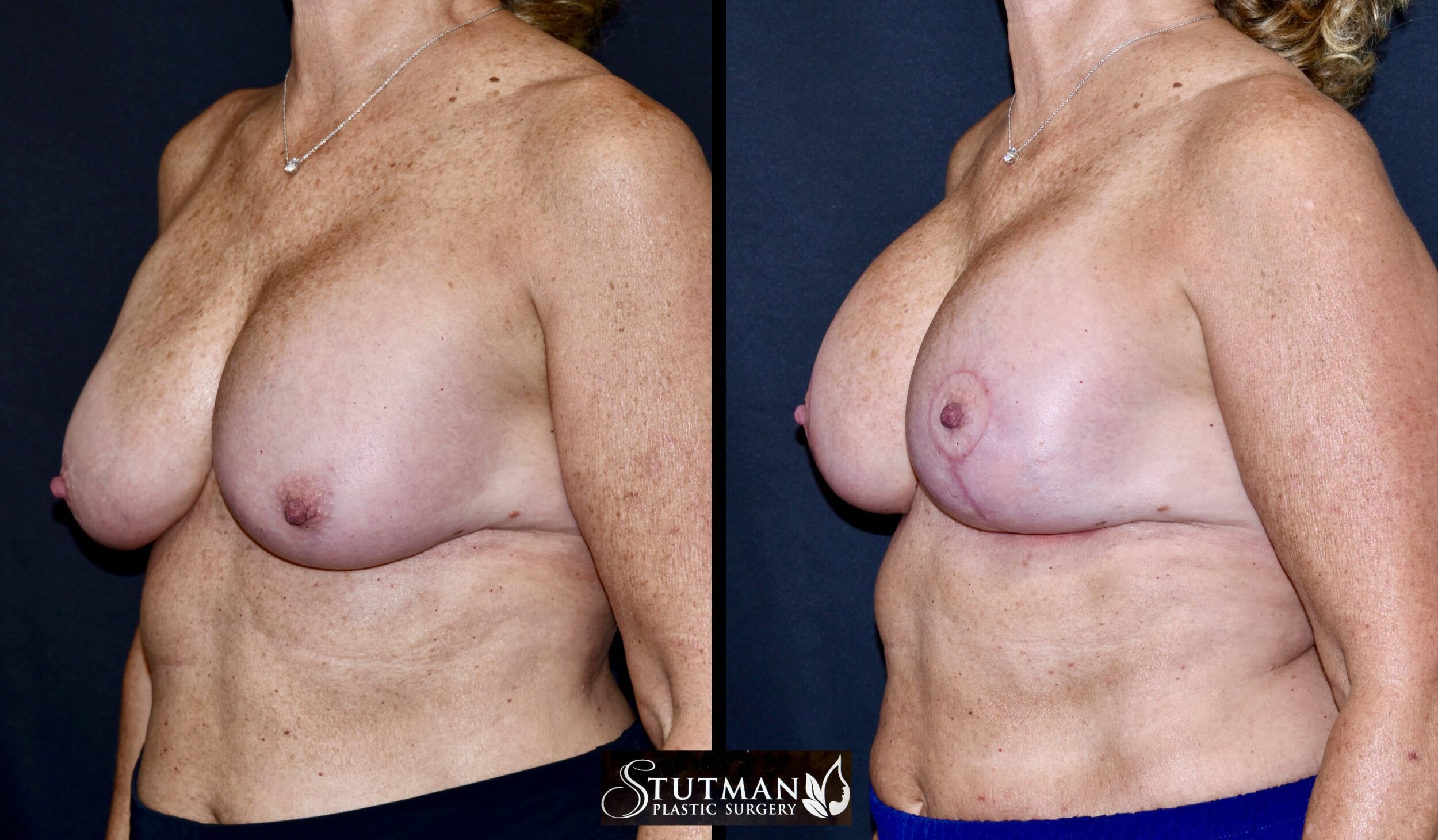 Before and After Image: Mastopexy (Breast Lift) - left-front-oblique