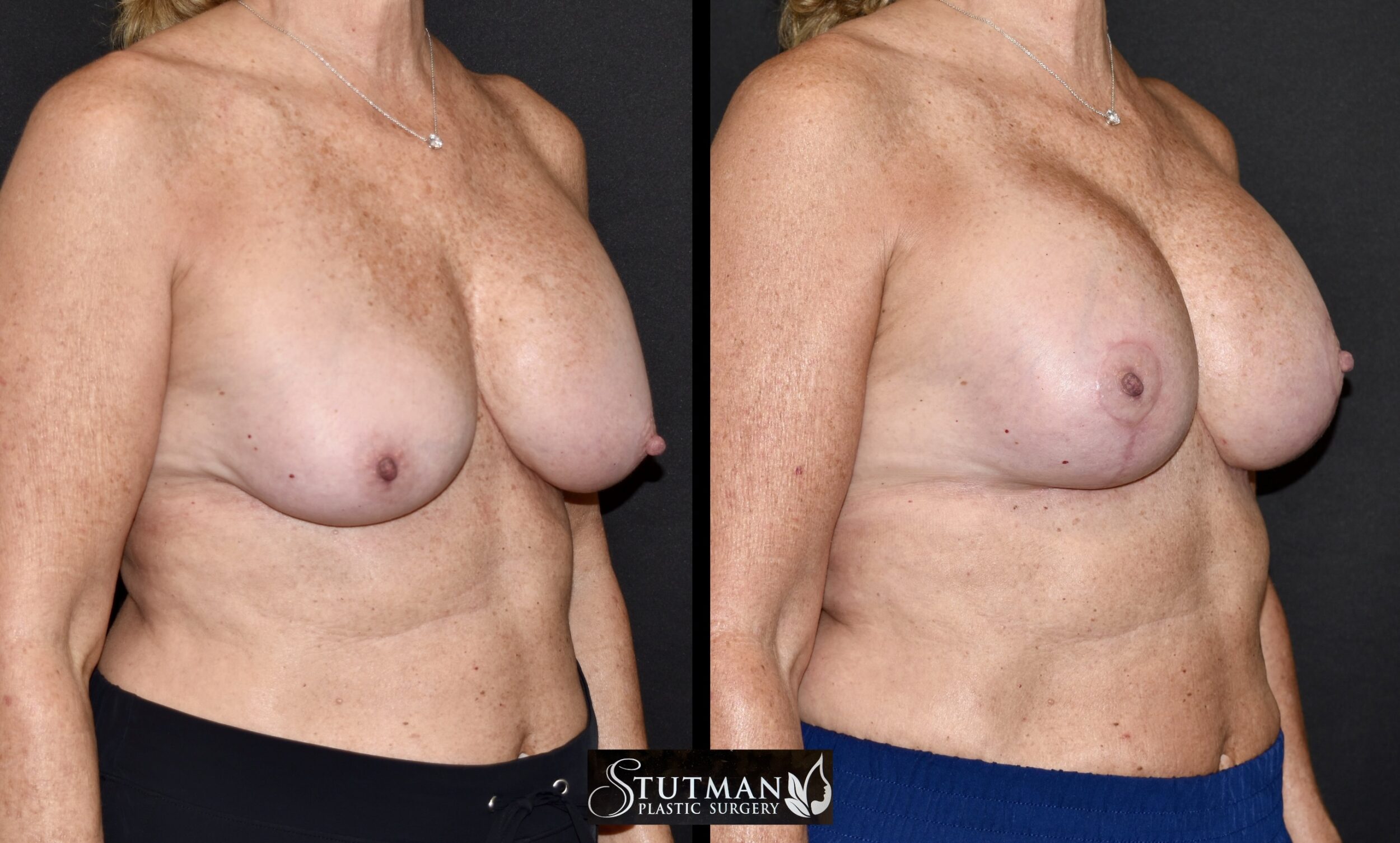 Before and After Image: Mastopexy (Breast Lift) - right-front-oblique