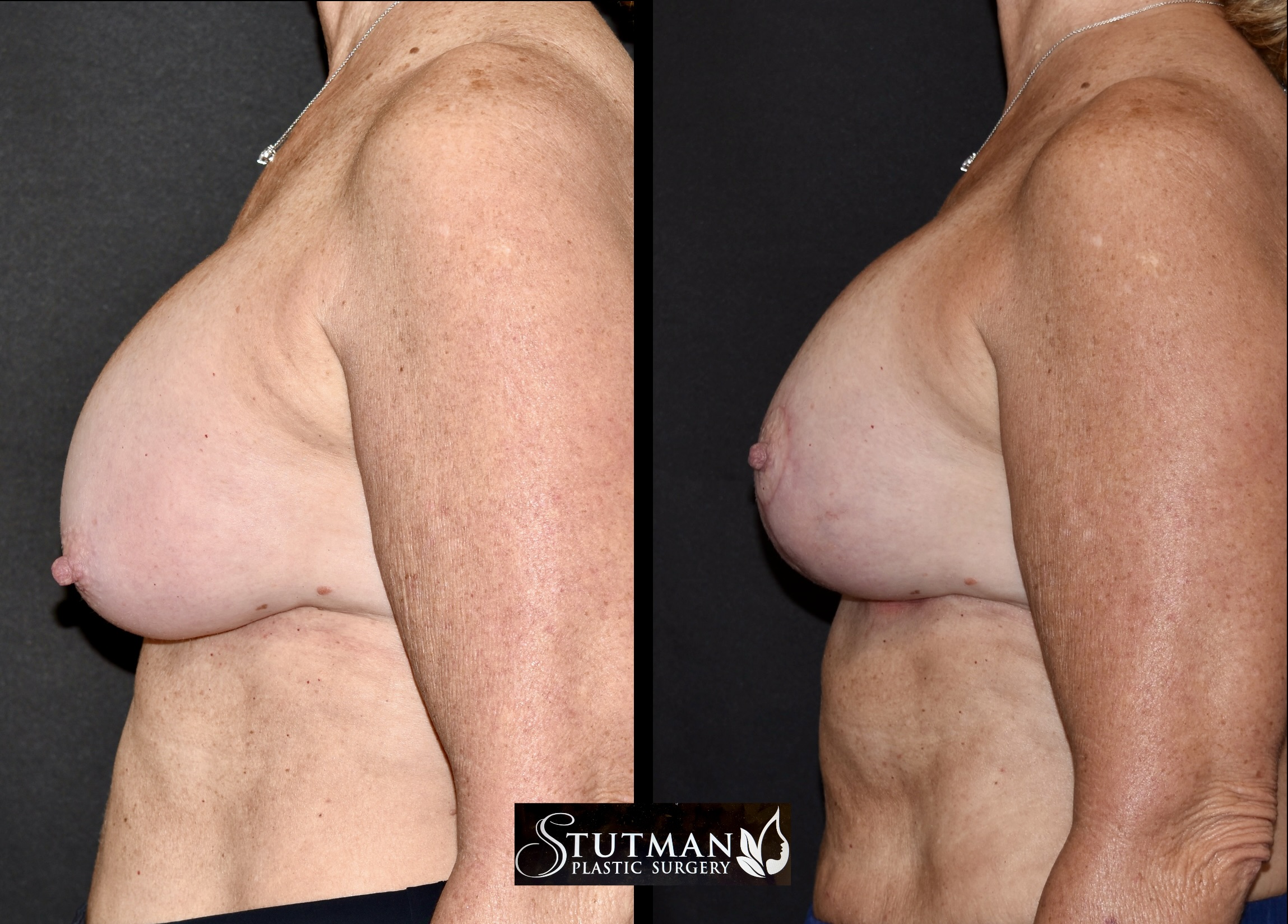 Before and After Image: Mastopexy (Breast Lift) - left-side