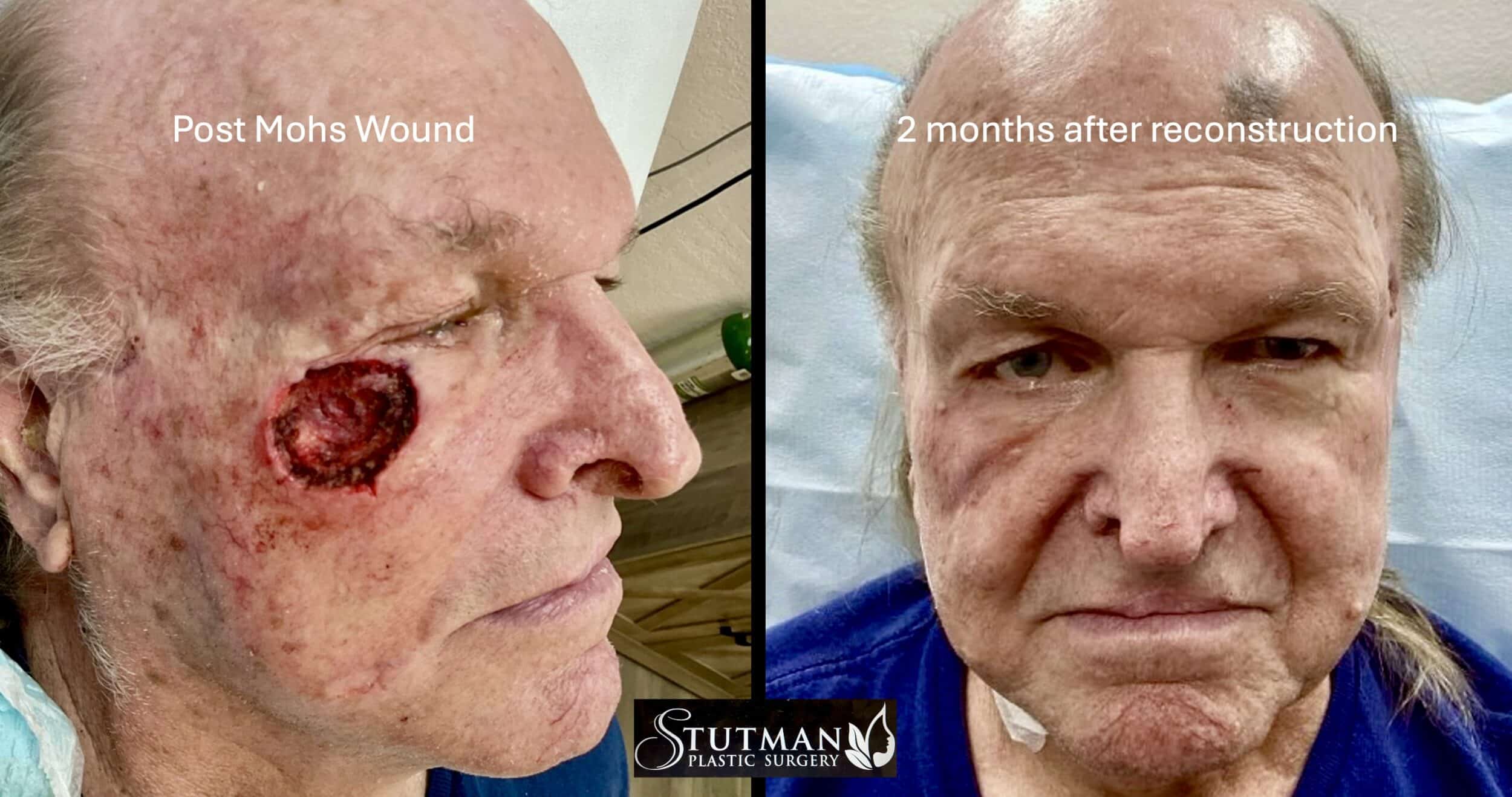 Before and After Image: Eye Skin Cancer - front