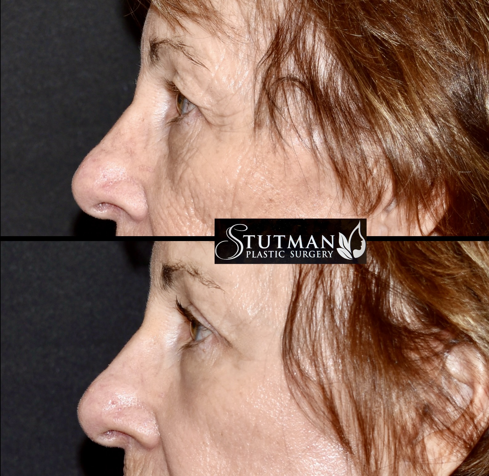 Before and After Image: Blepharoplasty - left-side