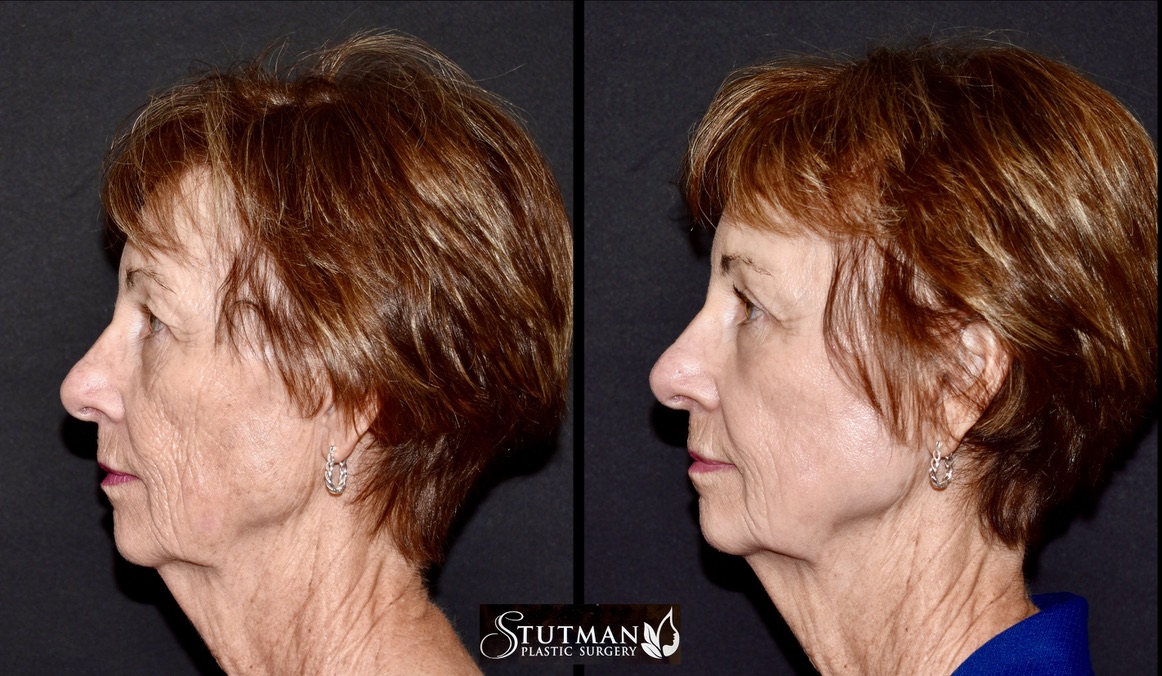 Before and After Image: Chemical Peel - left-side