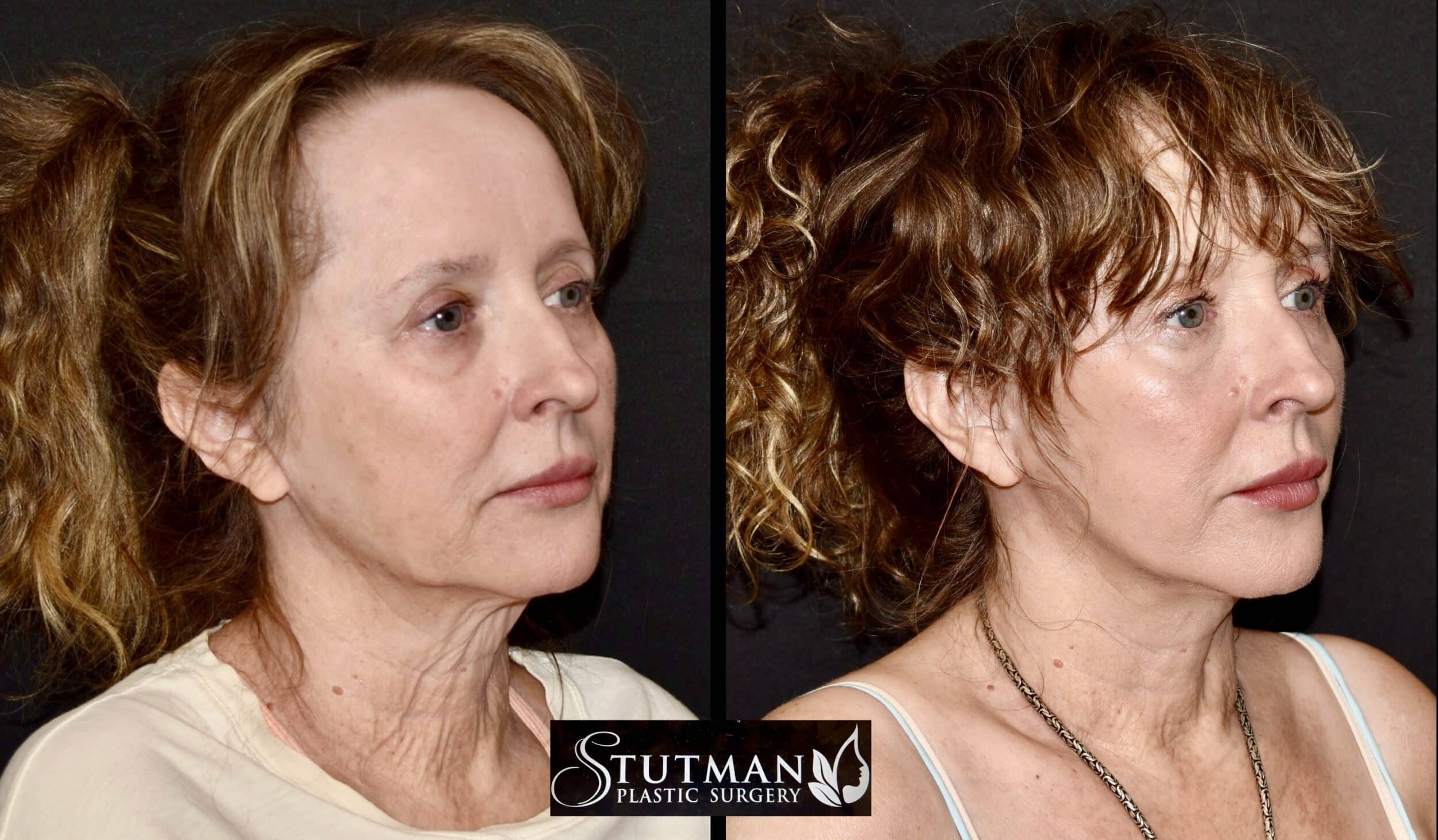 Before and After Image: Facelift / Necklift - right-front-oblique