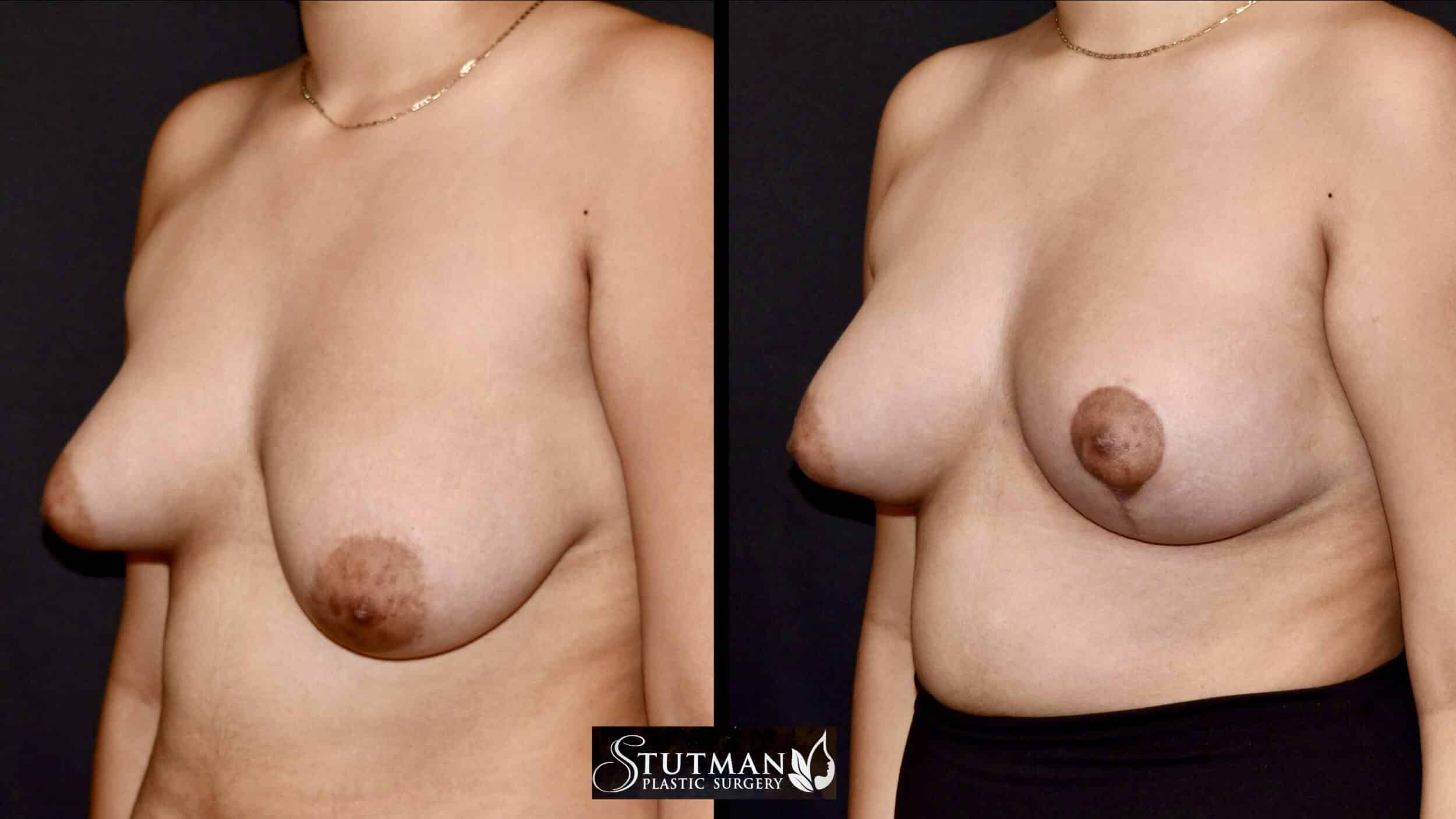 Before and After Image: Mastopexy - left-front-oblique
