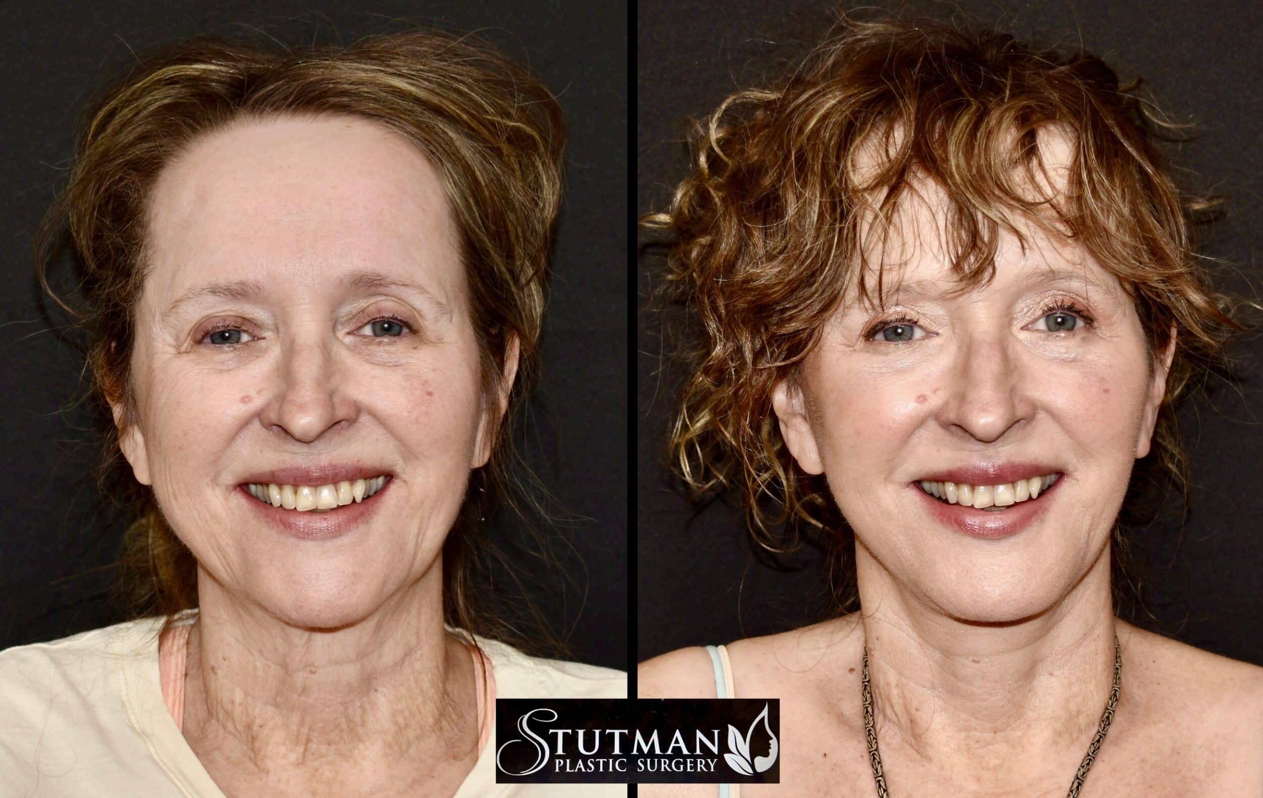 Before and After Image: Facelift / Necklift - front