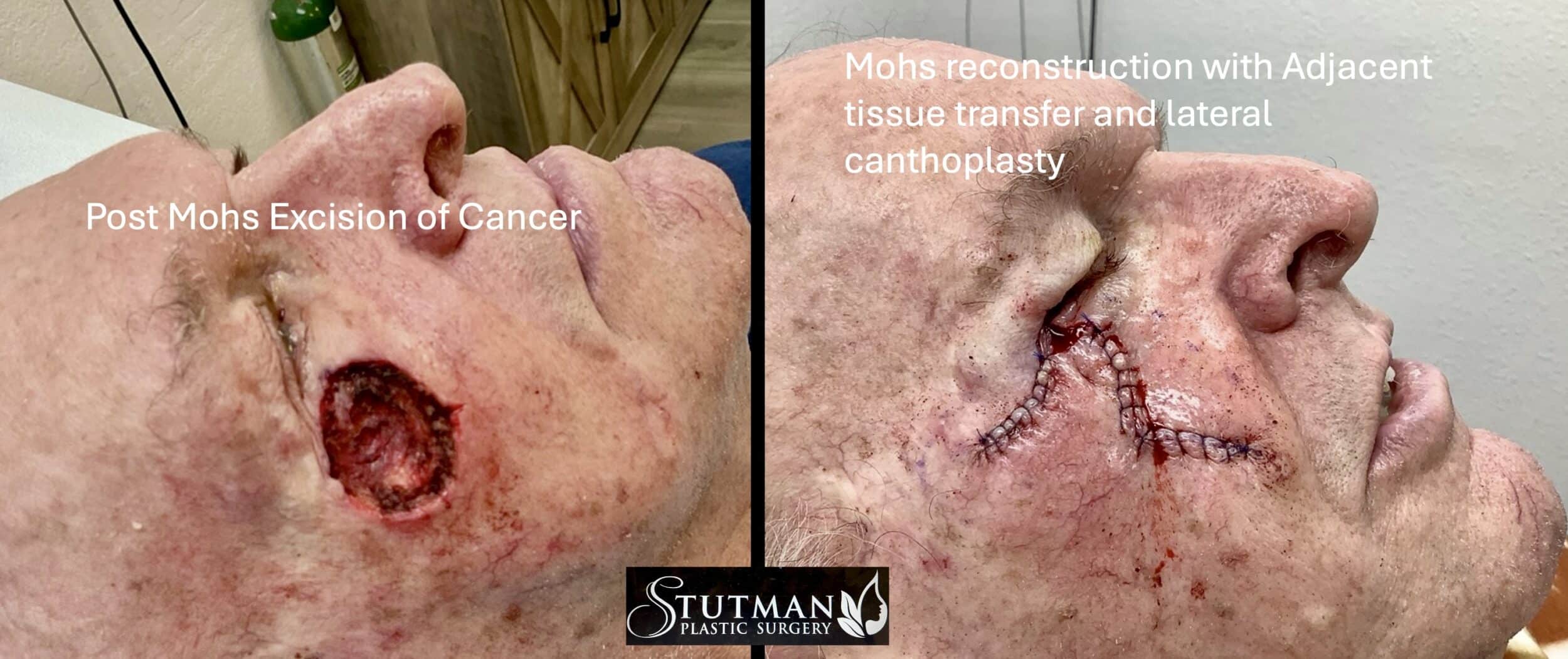Before and After Image: Eye Skin Cancer - right-side