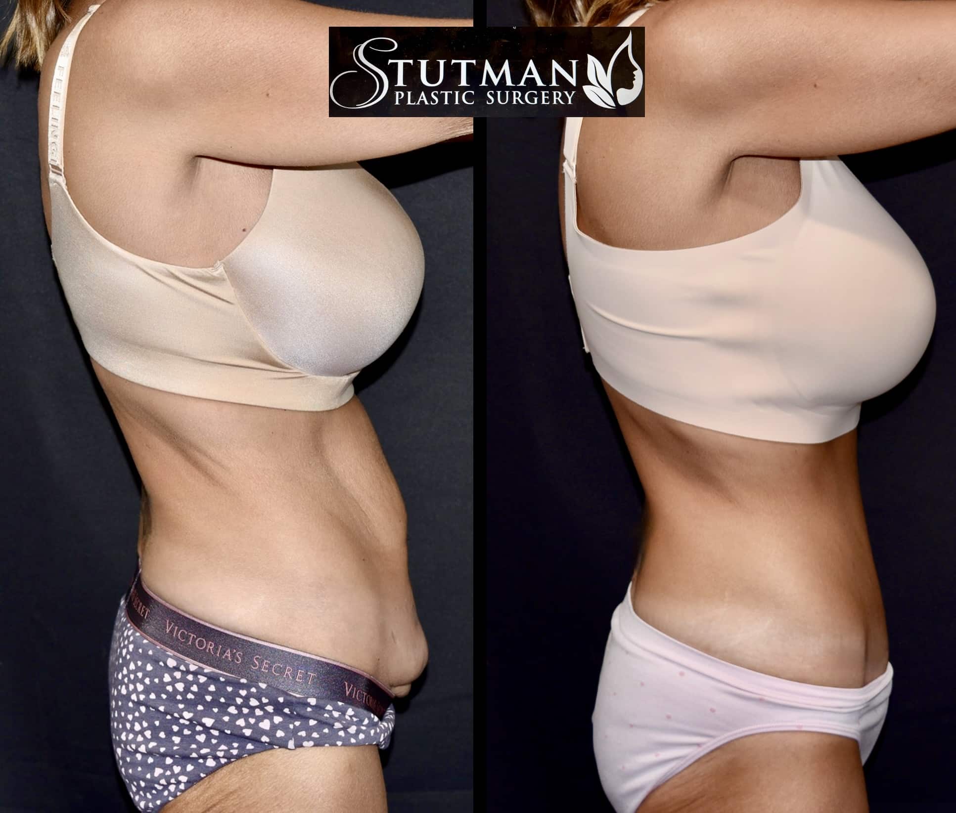 Before and After Image: Tummy Tuck - right-side