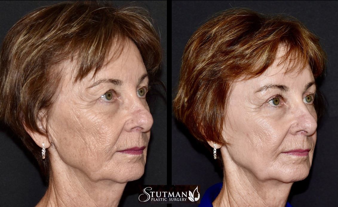 Before and After Image: Chemical Peel - right-front-oblique