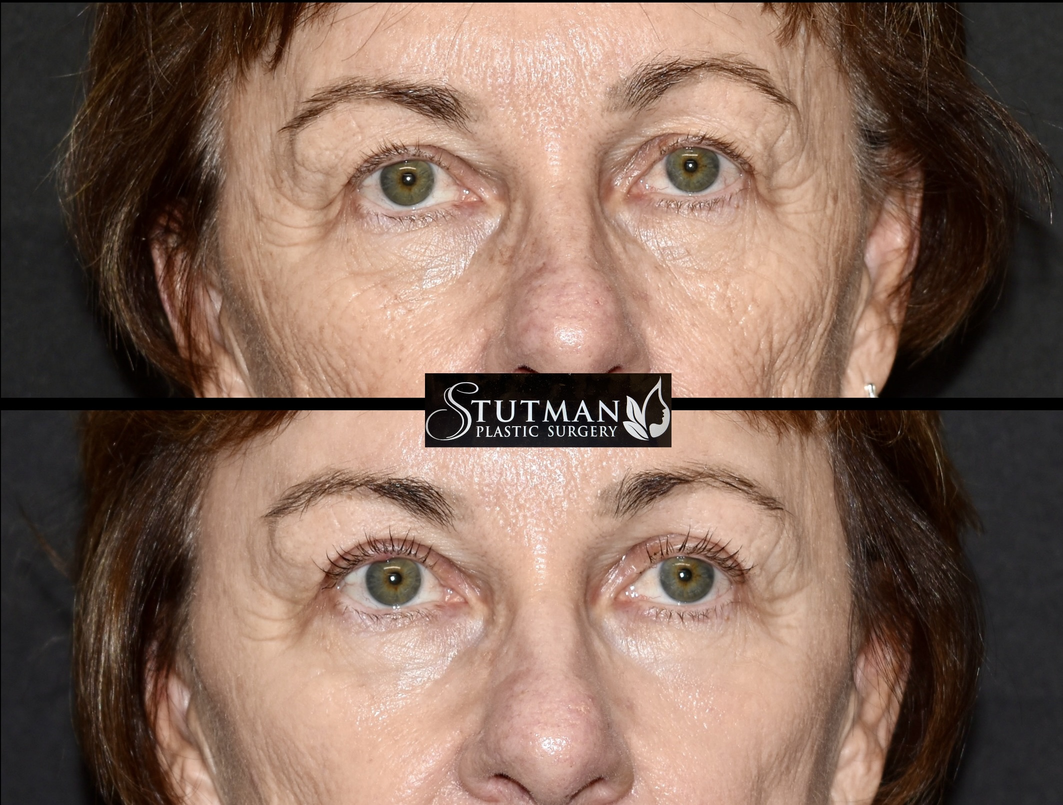 Before and After Image: Blepharoplasty - front