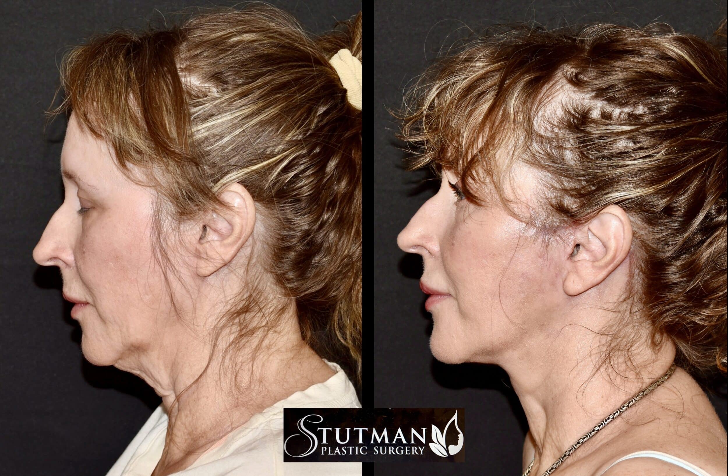 Before and After Image: Facelift / Necklift - left-side