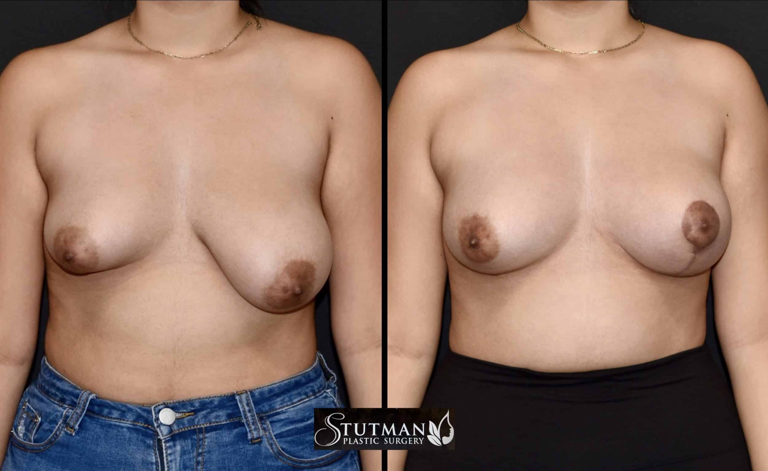 Before and After Image: Mastopexy - front