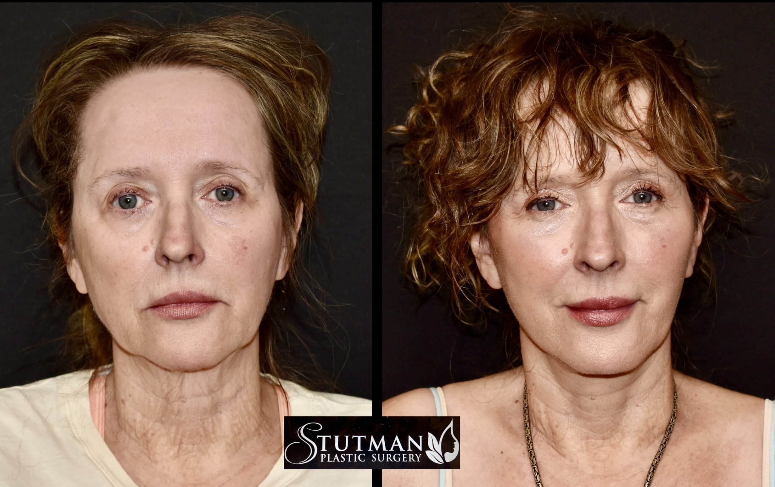 Before and After Image: Facelift / Necklift - front