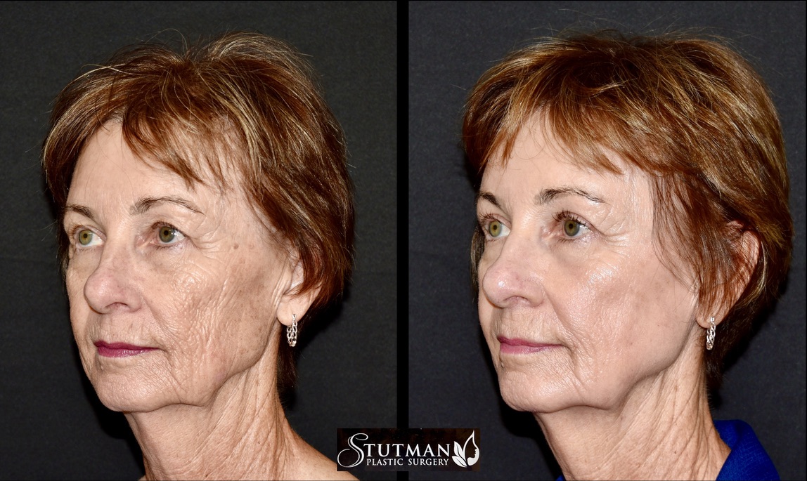 Before and After Image: Chemical Peel - left-front-oblique