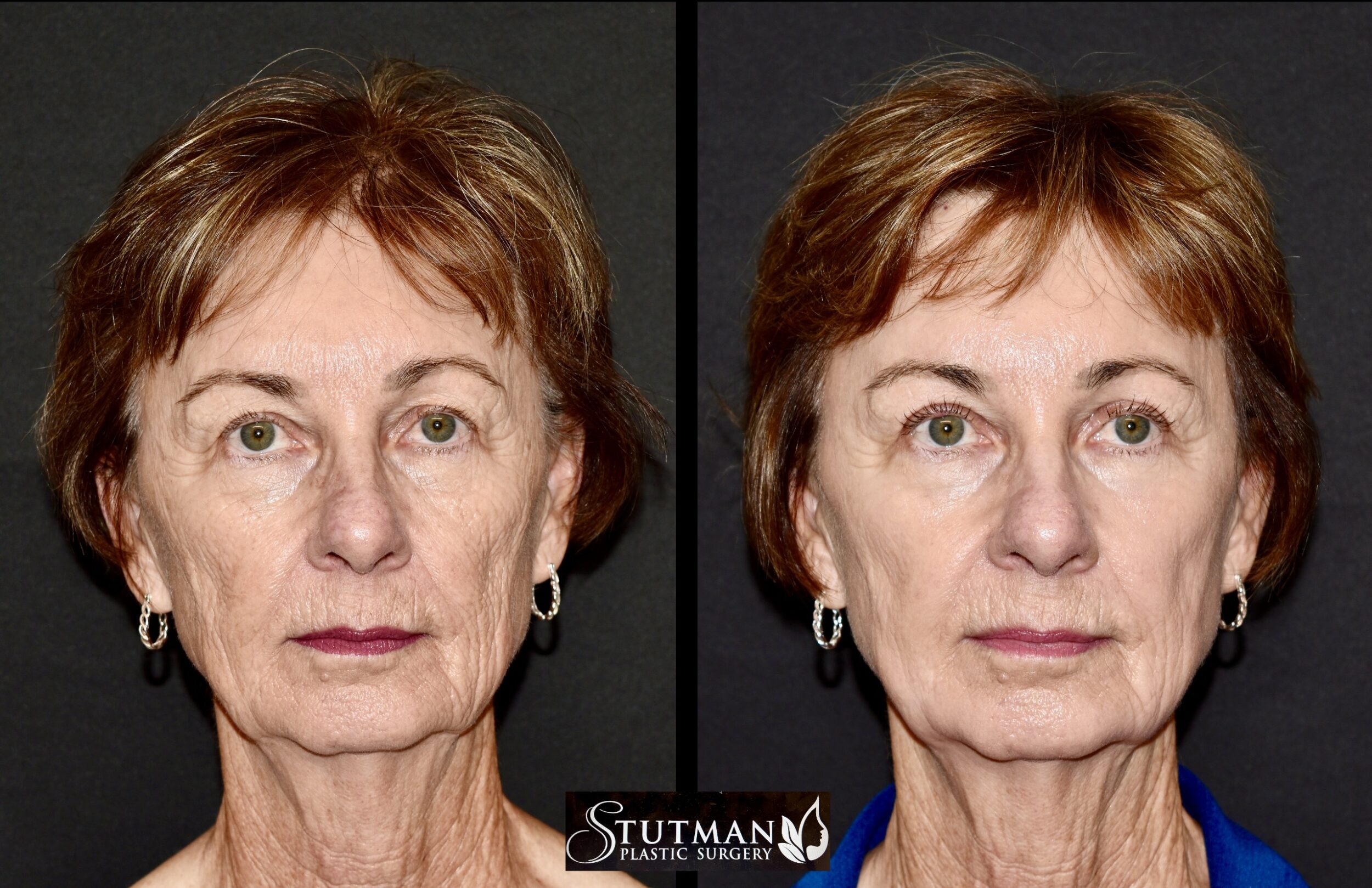 Before and After Image: Chemical Peel - front