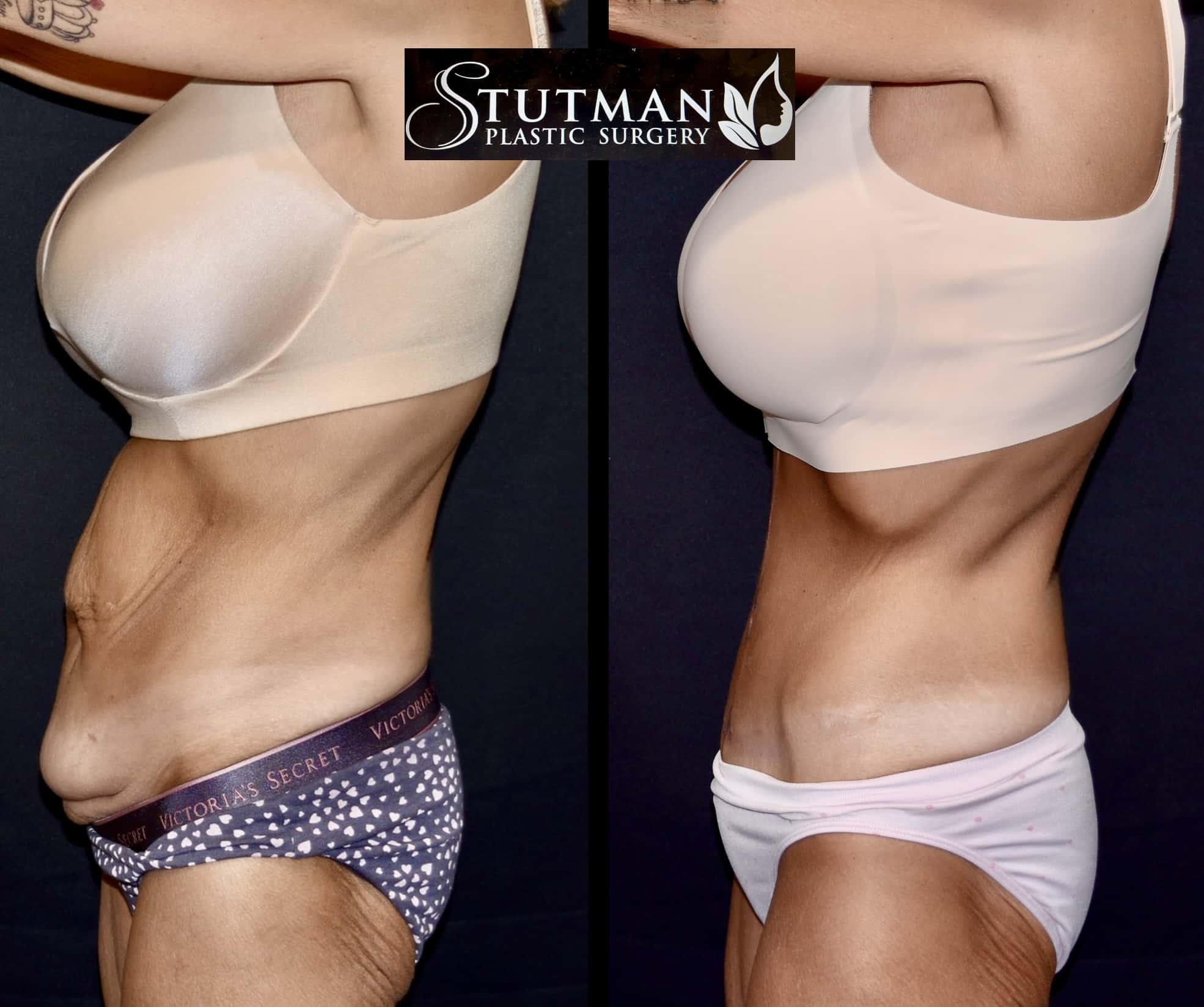 Before and After Image: Tummy Tuck - left-side