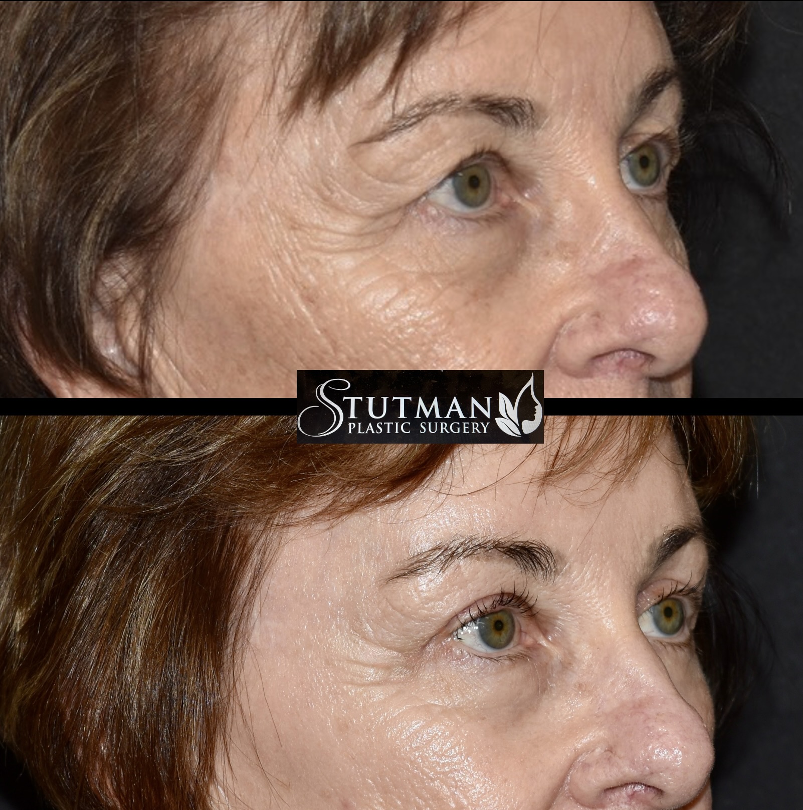 Before and After Image: Blepharoplasty - right-front-oblique