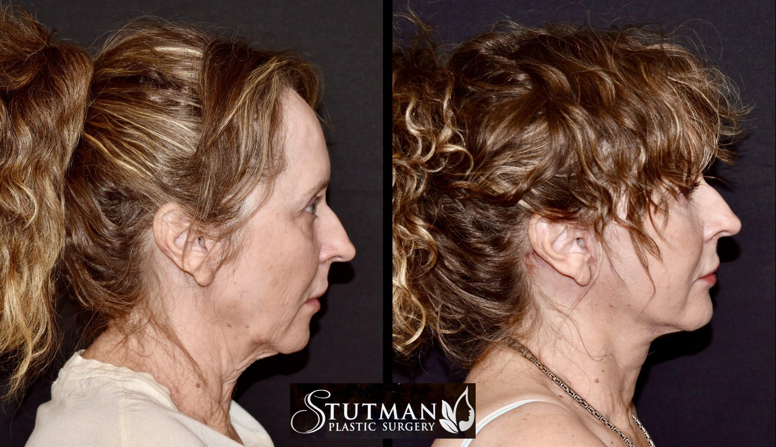 Before and After Image: Facelift / Necklift - right-side